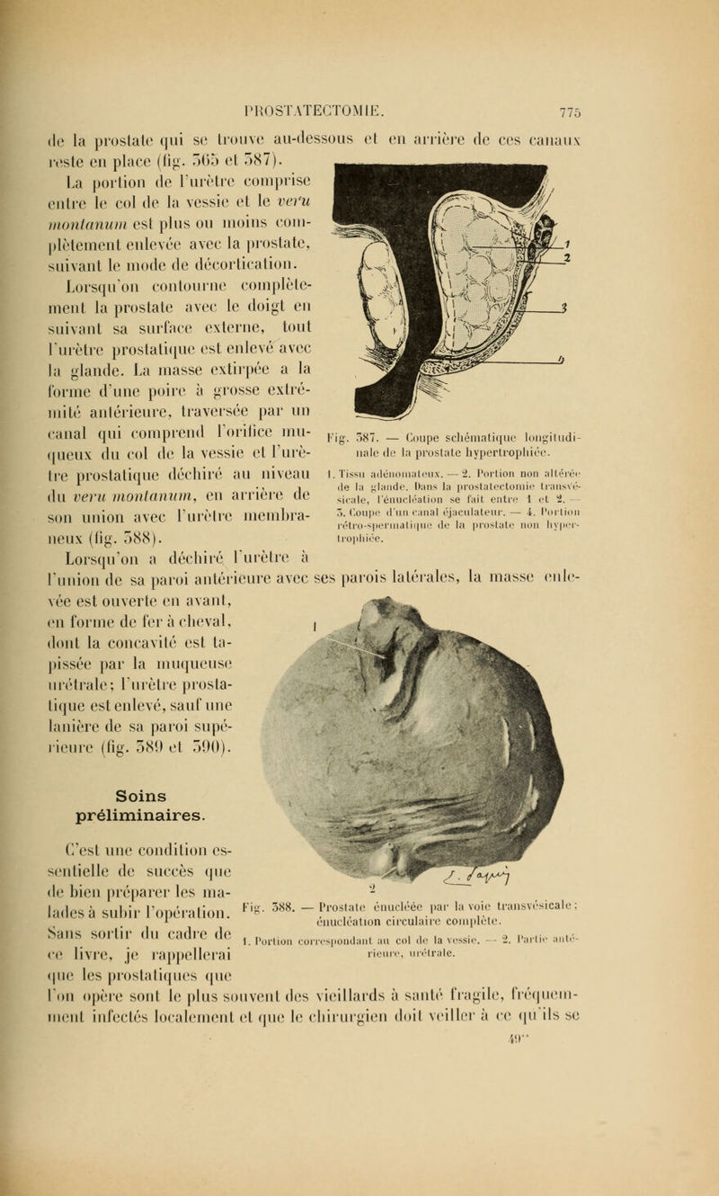 de la prostate qui se trouve au-dessous et eu arrière de ces canaux reste en place (fig. 565 et 387). La portion de l'urètre comprise entre le col de la vessie et le veru montanum est plus ou moins com- plètement enlevée avec la prostate, suivant le mode de décor tication. Lorsqu'on contourne complète- ment la prostate avec le doigt en suivant sa surface externe, tout l'urètre prostatique est enlevé avec la glande. La masse extirpée a la forme d'une poire à grosse extré- mité antérieure, traversée par un canal qui comprend l'orifice mu- queux du col de la vessie et l'urè- tre prostatique déchiré au niveau du veru montanum, en arrière de son union avec l'urètre membra- neux (fig. 588). Lorsqu'on a déchiré l'urètre à l'union de sa paroi antérieure avec ses parois latérales, la masse enle- vée est ouverte en avant, en forme de fer à cheval, dont la concavité est ta- pissée par la muqueuse urétrale; l'urètre prosta- tique est enlevé, sauf une lanière de sa paroi supé- rieure (fig. 589 et 590). Soins préliminaires. C'est une condition es- sentielle de succès que de bien préparer les ma- Fig. 387. — Coupe schématique longitudi- nale de la prostate hypertrophiée. 1. Tissu adénomaleux. — 2. Portion non altérée de la glande. Dans la prostatectomie transvé- sicjile, l'énucléation se l'ait entre 1 et 1 — 3. Coupe d'un canal éjaculateur. — A. Portion rétro-spermatique de la prostate non hyper- trophiée. Fig. 388. — Prostate éuucléée par la voie transvésicale énucléation circulaire complète. 1. Portion correspondant au col de la vessie. Heure, urétrale. Jades à suhir l'opération. Sans sortir du cadre de ce livre, je rappellerai que les prostatiques que l'on opère sont le plus souvent des vieillards à santé fragile, i nient infectés localement et que le chirurgien doit veiller à ce 2. l'art i re< M i uein- ils se