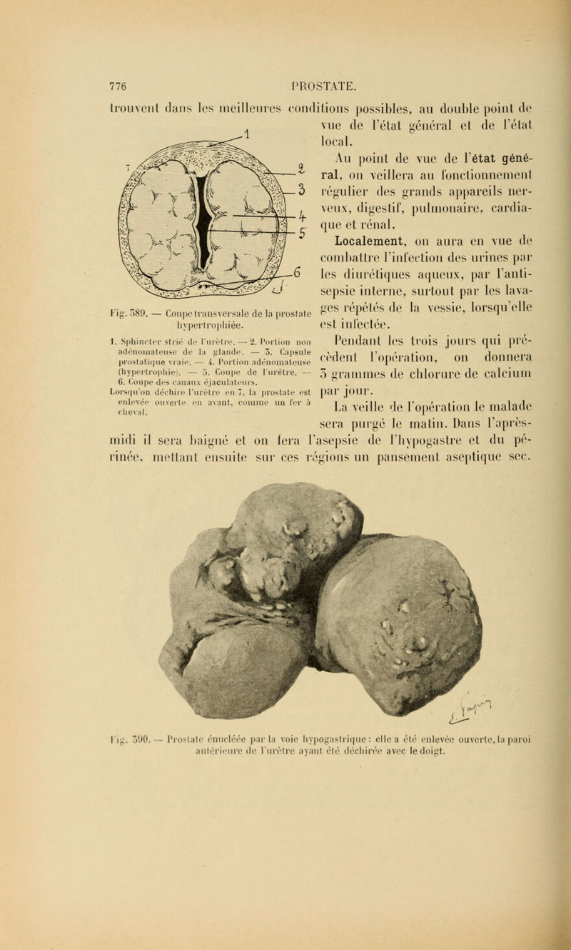 trouvent dans les meilleures conditions possibles, au double point de vue de l'état général et de Félat local. Au point de vue de l'état géné- ral, on veillera au fonctionnement régulier des grands appareils ner- veux, digestif, pulmonaire, cardia- que et rénal. Localement, on aura en vue de combattre l'infection des urines par les diurétiques aqueux, par l'anti- sepsie interne, surtout par les lava- ges répétés de la vessie, lorsqu'elle est infectée. Pendant les trois jours qui pré- cèdent l'opération, on donnera 3 grammes de chlorure de calcium par jour. La veille de l'opération le malade sera purgé le matin. Dans l'après- midi il sera baigné et on fera l'asepsie de Phypogastre et du pé- rinée, mettant ensuite sur ces régions un pansement aseptique sec. Fil 589. — Coupe transversale de la prostate hypertrophiée. 1. Sphincter strié de l'urètre. — 2. Portion non adénoinateuse de la glande. — 5. Capsule prostatique vraie. — -i. Portion adénomateuse (hypertrophiei. — 5. Coupe de l'urètre. — 6. Coupe des canaux éjaculateurs. Lorsqu'on déchire l'urètre en 7, la prostate est enlevée ouverte en avant, comme un ter à cheval. I ig. 390. - Prostate énucléée parla voie liypogastrique : elle a été enlevée ouverte, la paroi antérieure de l'urètre ayant été déchirée avec le doigt.