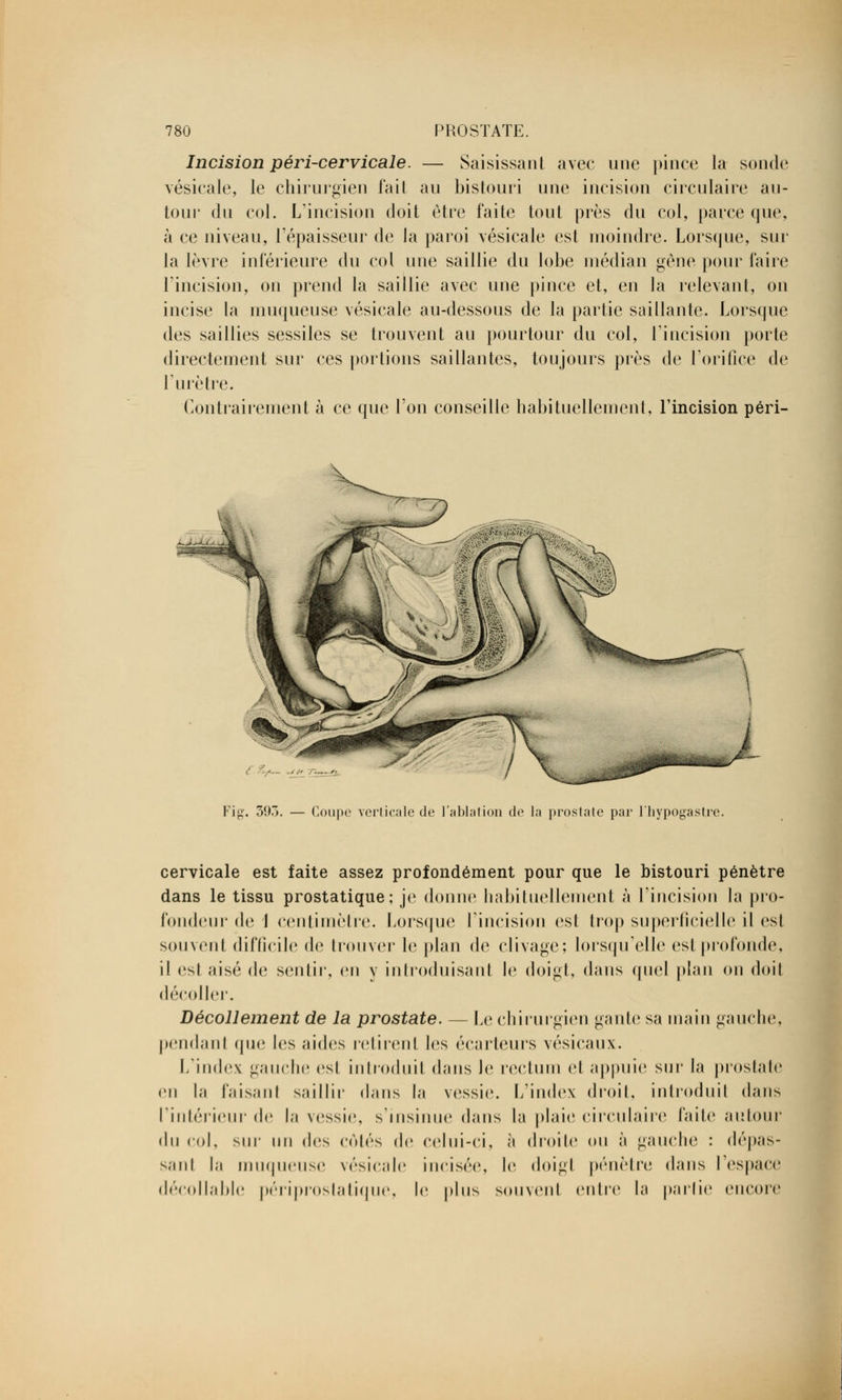 Incision péri-cervicale. — Saisissant avec une pince la sonde vésicale, le chirurgien fait au bistouri une incision circulaire au- tour du col. L'incision doit être faite tout près du col, parce que, à ce niveau, l'épaisseur de la paroi vésicale est moindre. Lorsque, sur la lèvre inférieure du col une saillie du lobe médian gène pour faire l'incision, on prend la saillie avec une pince et, en la relevant, on incise la muqueuse vésicale au-dessous de la partie saillante. Lorsque des saillies sessiles se trouvent au pourtour du col, l'incision porte directement sur ces portions saillantes, toujours près de l'orifice de l'urètre. Contrairement à ce que l'on conseille habituellement, l'incision péri- ,,,-^j / \ Fig. 393. — Coupe verticale de Tablai ion de la prostate par l'hypogastre. cervicale est faite assez profondément pour que le bistouri pénètre dans le tissu prostatique; je donne habituellement à l'incision la pro- fondeur de ] centimètre. Lorsque l'incision est trop superficielle il est souvent difficile de trouver le plan de clivage; lorsqu'elle est profonde, il esl aisé de sentir, en y introduisant le doigt, dans quel plan on doit décoller. Décollement de la prostate. — Le chirurgien gante sa main gauche, pendant que les aides retirent les écarteurs vésicaux. L'index gauche esl introduit dans le rectum et appuie sur la prostate en la faisan 1 saillir dans la vessie. L'index droit, introduit dans l'intérieur de la vessie, s'insinue dans la plaie circulaire faite autour du col, sur un des côtés de celui-ci, <à droite ou à gauche : dépas- sant la muqueuse vésicale incisée, le doigl pénètre dans l'espace décollable périproslatique, le plus souvent entre la parlie encore