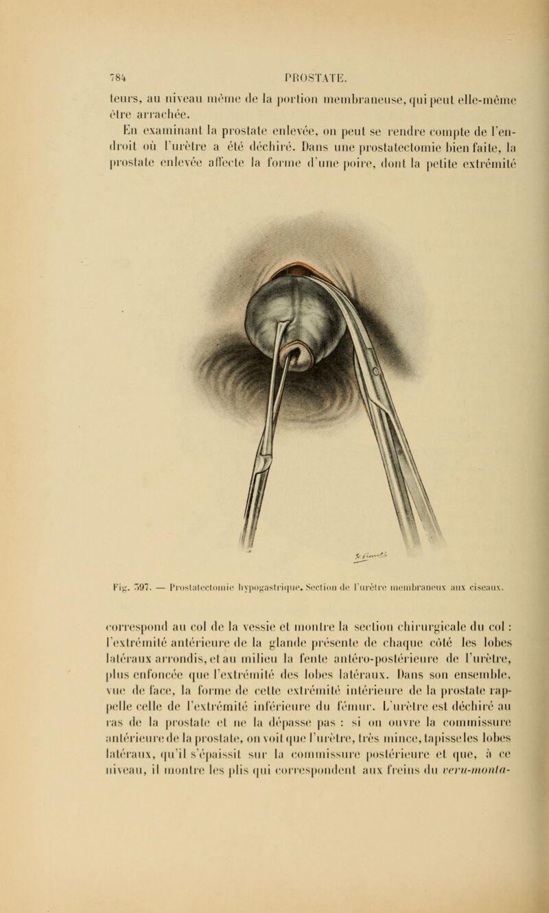 teurs, au niveau même de la portion membraneuse, qui peut elle-même être arrachée. En examinant la prostate enlevée, on peut se rendre compte de l'en- droit où l'urètre a été déchiré. Dans une prostatectomie bien faite, la prostate enlevée affecte la forme d'une poire, dont la petite extrémité Fig. )97. — Prostatectomie liypogastrique. Section de ['urètre membraneux aux ciseaux. correspond au col de la vessie et mon lie la section chirurgicale du col : l'extrémité antérieure de la glande présente de chaque côté les lobes latéraux arrondis, et au milieu la fente antéro-postérieure de l'urètre, plus enfoncée que l'extrémité des lobes latéraux. Dans son ensemble, vue de face, la forme de cette extrémité intérieure de la prostate rap- pelle celle de l'extrémité inférieure (\u fémur. L'urètre est déchiré au ras de la prostate et ne la dépasse pas : si on ouvre la commissure antérieurede la prostate, on voit que l'urètre, liés mince, tapisseles lobes latéraux, qu'il s'épaissit sur la commissure postérieure et que, à ce niveau, il montre les plis qui correspondent aux freins du veru-monta-