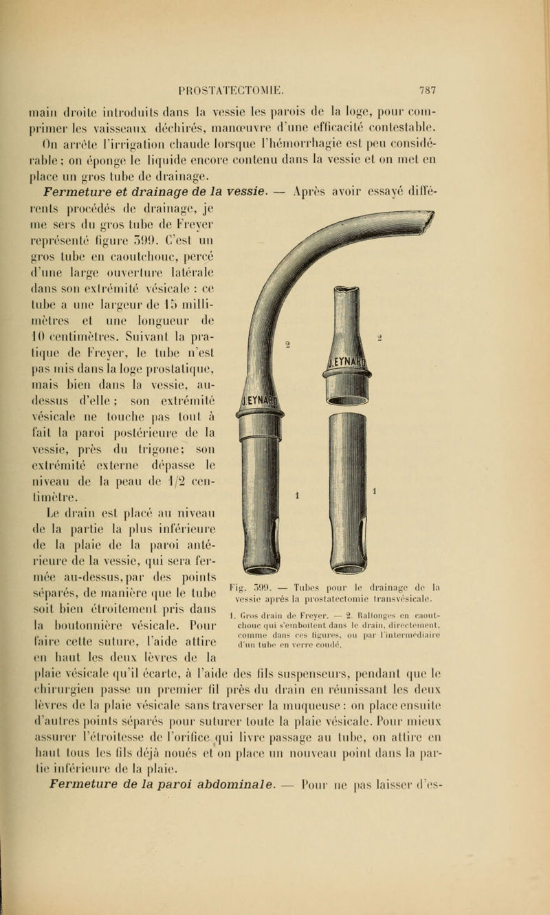 Après avoir essayé difïe- main droite introduits dans la vessie les parois de la loge, pour com- primer les vaisseaux déchirés, manœuvre d'une efficacité contestable. On arrête l'irrigation chaude lorsque l'hémorrhagie est peu considé- rable ; on éponge le liquide encore contenu dans la vessie et on met en place un gros tube de drainage. Fermeture et drainage de la vessie. rents procédés de drainage, je me sers du gros tube de Freyer représenté figure 599. C'est un gros tube en caoutchouc, percé (rime large ouverture latérale dans son extrémité vésicale : ce tube a une largeur de 15 milli- mètres et une longueur de 10 centimètres. Suivant la pra- tique de Freyer, le tube n'est pas mis dans la loge prostatique, mais bien dans la vessie, au- dessus d'elle ; son extrémité vésicale ne touche pas tout à fait la paroi postérieure de la vessie, près du trigone; son extrémité externe dépasse le niveau de la peau de 1/2 cen- timètre. Le drain est placé au niveau de la partie la plus inférieure de la plaie de la paroi anté- rieure de la vessie, qui sera fer- mée au-dessus,par des points séparés, de manière que le tube soit bien étroitement pris dans la boutonnière vésicale. Pour Caire cette suture, l'aide attire en haut les deux lèvres de la plaie vésicale qu'il écarte, à l'aide des fils suspenseurs, pendant que le chirurgien passe un premier fil près du drain en réunissant les deux lèvres de la plaie vésicale sans traverser la muqueuse: on place ensuite d'autres points séparés pour suturer toute la plaie vésicale. Pour mieux assurer l'étroitesse de l'orifice qui livre passage au tube, on attire en haut Ions les (ils déjà noués et un place un nouveau point dans la par- lie inférieure de la plaie. Fermeture de la paroi abdominale. — Pour ne pas laisser d'es- Fig. 399. — Tubes pour le drainage de la vessie après la prostatectomie Iransvésicale. 1. Gros drain de Freyer. — 2. Rallonges en caout- chouc qui s'emboîtent dans le drain, directement, comme dans ces ligures, ou par l'intermédiaire d'un tube en verre coudé.