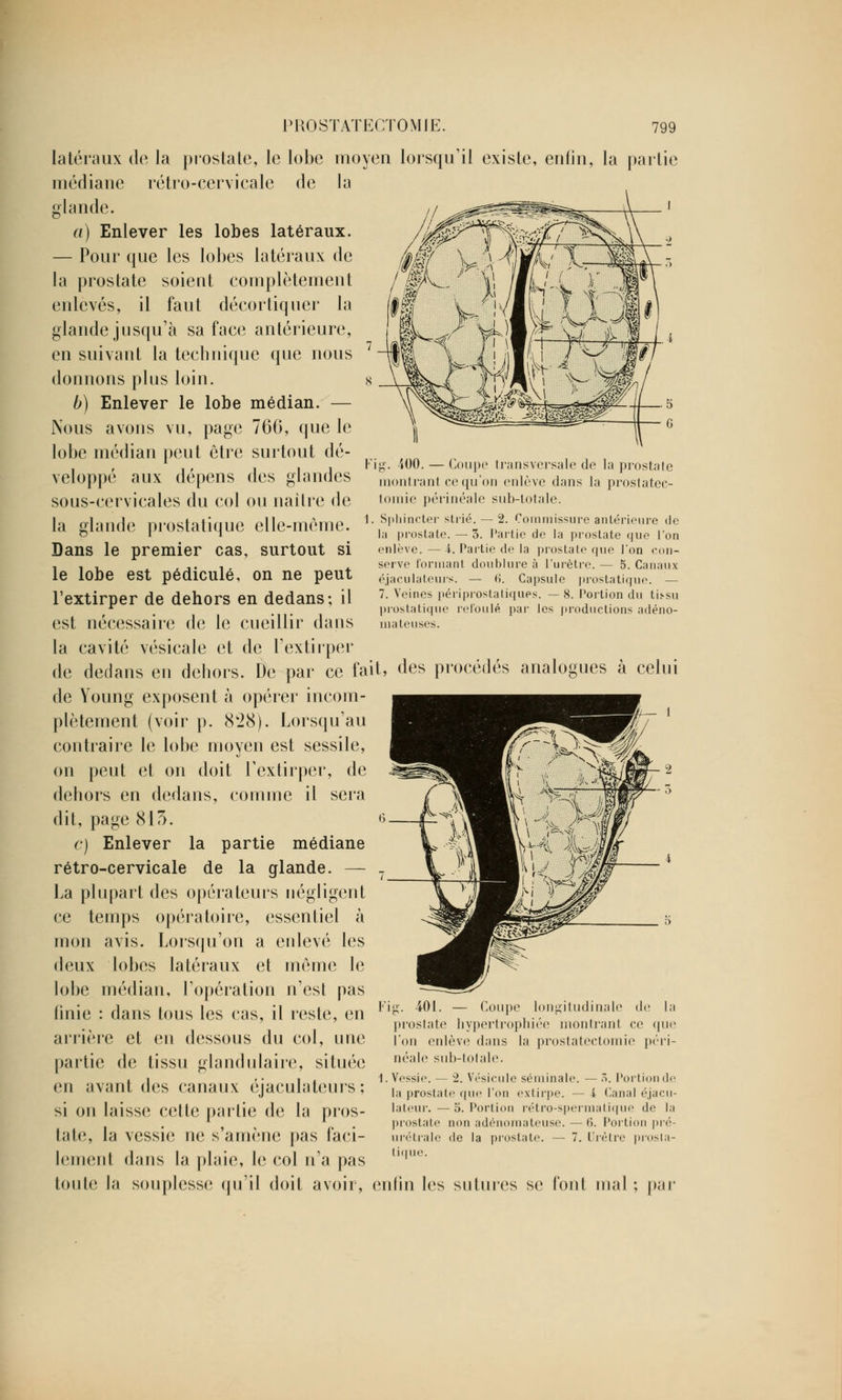 latéraux de la prostate, le lobe moyen lorsqu'il existe, enfin, la partie médiane rétro-cervicale de la glande. a) Enlever les lobes latéraux. — Pour que les lobes latéraux de la prostate soient complètement enlevés, il faut décortiquer la glande jusqu'à sa face antérieure, en suivant la technique que nous donnons plus loin. b) Enlever le lobe médian. — Nous avons vu, page 766, que le lobe médian peut être surtout dé- veloppé aux dépens des glandes sous-cervicales du col ou naître de la glande prostatique elle-même. Dans le premier cas, surtout si le lobe est pédicule, on ne peut l'extirper de dehors en dedans; il est nécessaire de le cueillir dans la cavité vésicale et de l'extirper de dedans en dehors. De par ce fait, de Young exposent à opérer incom- plètement (voir p. 828). Lorsqu'au contraire le lobe moyen est sessile, on peut et on doit l'extirper, de dehors en dedans, comme il sera dit, page 815. c) Enlever la partie médiane rétro-cervicale de la glande. — La plupart des opérateurs négligent ce temps opératoire, essentiel à mon avis. Lorsqu'on a enlevé les deux lobes latéraux et même le lobe médian, l'opération n'est pas finie : dans tous les cas, il reste, en arrière et en dessous du col, une partie de tissu glandulaire, située en avant des canaux éjaculateurs ; si on laisse cette partie de la pros- tate, la vessie ne s'amène pas faci- lement dans la plaie, le col n'a pas toute la souplesse qu'il doit avoir, Fig. 400. — Coupe transversale de la prostate montrant, ce qu'on enlève dans la prostatec- tomie périnéale sub-totale. 1. Sphincter strié. — 2. Commissure antérieure de la prostate. —3. Partie de la prostate que l'on enlève. — I. Partie de la prostate que l'on con- serve formant doublure à l'urètre. — 5. Canaux éjaculateurs. — 6. Capsule prostatique. — 7. Veines périprostatiques. — 8. Portion du tis>su prostatique refoulé par les productions adéno- mateuses. des procédés analogues à celui Fig. 401. — Coupe longitudinale de la prostate hypertrophiée montrant ce que l'on enlève dans la prostatectomie péri- néale sub-totale. 1. Vessie. — 2. Vésicule séminale. — ô. Portion de la prostate que l'on extirpe. — i Canal é.jacu- lateur. —5. Portion rétro-spermatique de la prostate non adénomateuse. —(>. Portion pré- urétrale de la prostate. — 7. Prêtre prosta- tique. enfin les sutures se font mal par