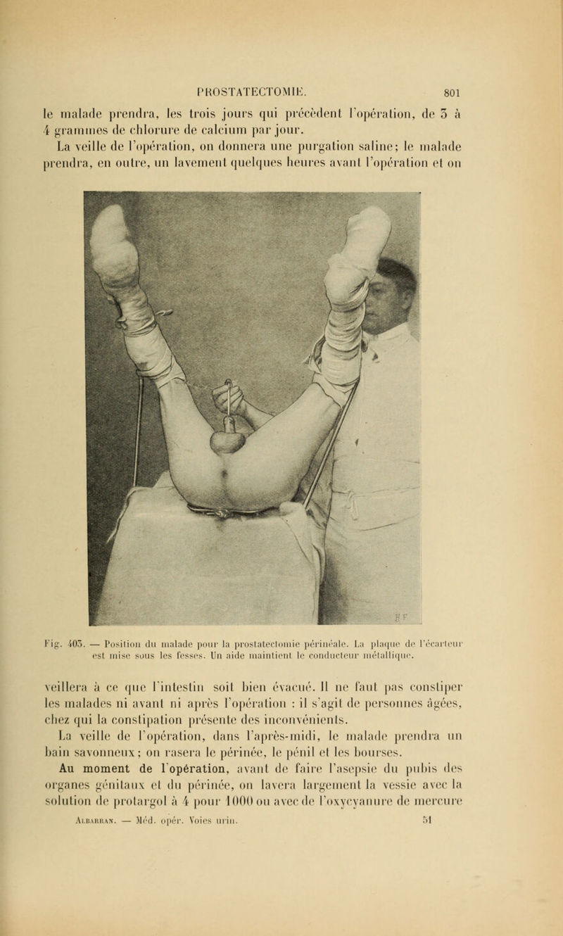 le malade prendra, les trois jours qui précèdent l'opération, de 3 à 4 grammes de chlorure de calcium par jour. La veille de l'opération, on donnera une purgation saline; le malade prendra, en outre, un lavement quelques heures avant l'opération et on Fig. 405. — Position du malade pour la prostateciomie périnéale. La plaque do l'écarteur est mise sous les fesses. Un aide maintient, le conducteur métallique. veillera à ce que l'intestin soit bien évacué. 11 ne faut pas constiper les malades ni avant ni après l'opération : il s'agit de personnes âgées, chez qui la constipation présente des inconvénients. La veille de l'opération, dans l'après-midi, le malade prendra un bain savonneux; on rasera le périnée, le pénil et les bourses. Au moment de l'opération, avant de faire l'asepsie du pubis des organes génitaux et du périnée, on lavera largement la vessie avec la solution de protargol à i pour 1000 ou avec de l'oxycyanure de mercure Albarran. — Méd. opér. Voies uiiu. 51