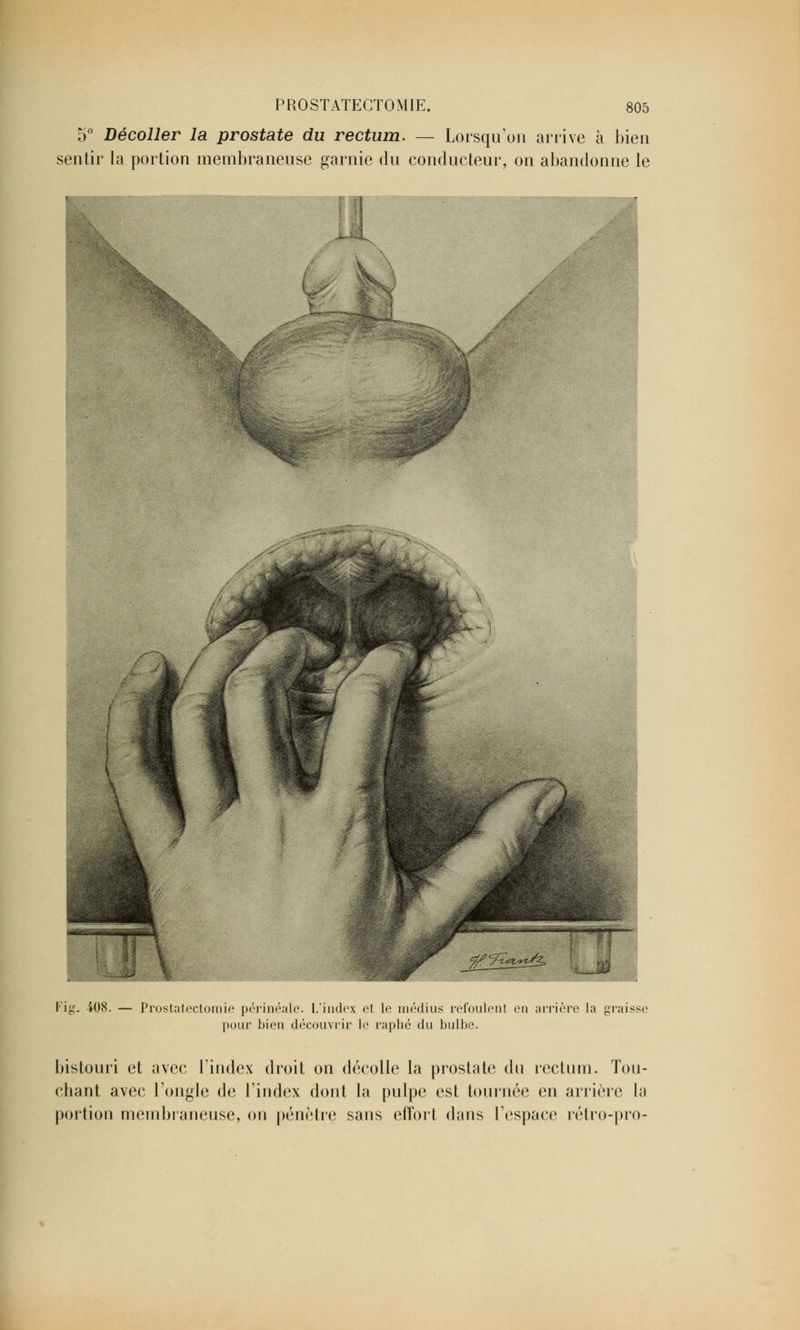 5° Décoller la prostate du rectum. — Lorsqu'on arrive à bien sentir la portion membraneuse garnie du conducteur, on abandonne le Fig. 408. — Prostatcctomie périnéale. L'index et le médius refoulent en arrière la graisse pour bien découvrir le raphé du bulbe. bistouri et avec l'index droit on décolle la prostate du rectum. Tou- chant avec l'ongle de l'index dont la pulpe est tournée en arrière la portion membraneuse, on pénètre sans effort dans l'espace rétro-pro-