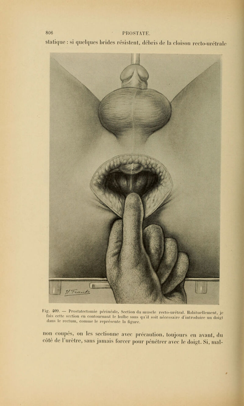 statique : si quelques brides résistent, débris de la cloison recto-urétrale 'ig. 409. — Prostatectomie périnéale. Section du muscle recto-urétral. Habituellement, je fais cette section en contournanl le bulbe sans qu'il soil nécessaire d'introduire un doigl dans le rectum, comme le représente la figure. non coupés, on les sectionne avec précaution, toujours en avant, du côté <\i> l'urètre, sans jamais forcer pour pénétrer avec le doigt. Si, mal-