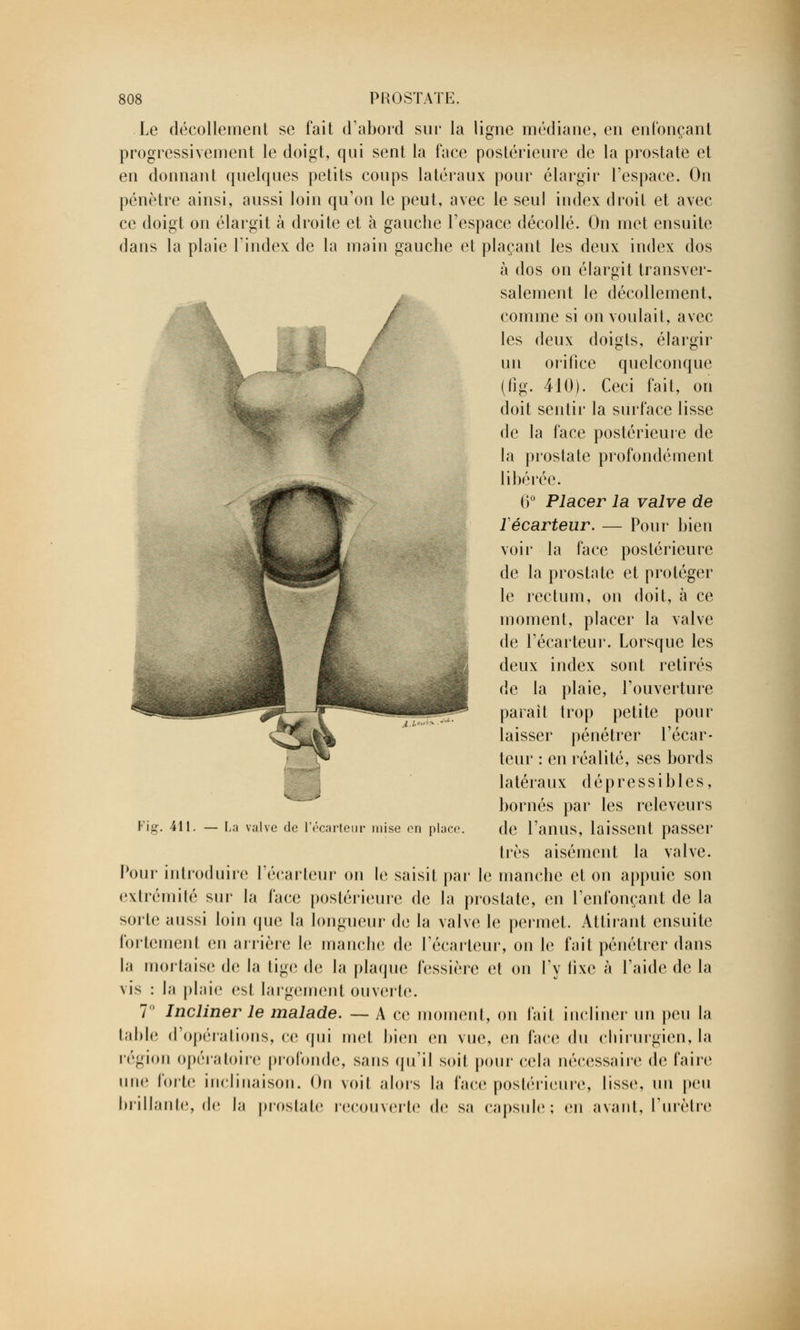 Le décollement se fait d'abord sur la ligne médiane, en enfonçant progressivement le doigt, qui sent la face postérieure de la prostate et en donnant quelques petits coups latéraux pour élargir l'espace. On pénètre ainsi, aussi loin qu'on le peut, avec le seul index droit et avec ce doigt on élargit à droite et à gauche l'espace décollé. On met ensuite dans la plaie l'index de la main gauche et plaçant les deux index dos à dos on élargit transver- salement le décollement, comme si on voulait, avec les deux doigts, élargir un orifice quelconque (fig. 410). Ceci fait, on doit sentir la surface lisse de la face postérieure de la p rosi a te profondément libérée. 6° Placer la valve de ïécarteur. — Pour bien voir la face postérieure de la prostate et protéger le rectum, on doit, à ce moment, placer la valve de l'écarteur. Lorsque les deux index sont retirés de la plaie, l'ouverture parait trop petite pour laisser pénétrer l'écar- teur : en réalité, ses bords latéraux dépressibles, bornés par les releveurs de l'anus, laissent passer liés aisément la valve. Pour introduire l'écarteur on le saisit par le manche et on appuie son extrémité sur la face postérieure de la prostate, en l'enfonçant de la sorte aussi loin que la longueur de la valve le permet. Attirant ensuite fortement en arrière le manche de l'écarteur, on le fait pénétrer dans la mortaise de la tige de la plaque fessière cl on l'y fixe à l'aide de la vis : h» plaie est largement ouverte. 7° Incliner le malade. — A ce moment, on fait incliner' un peu la table d'opérations, ce qui met bien err vire, en face du chirurgien, la région opératoire profonde, sans qu'il soit pour* cela nécessaire de taire une forte inclinaison. On voit alors la face postérieure, lisse, un peu brillante, de la prostate recouverte de sa capsule; en avant, l'urètre Fig. 411. — La valve de l'écarteur mise en place.