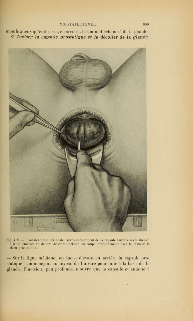 membraneux qu'embrasse, en arrière, le sommet échancré de la glande. 8° Inciser la capsule prostatique et la décoller de la glande. .V WÊÊÊÊm Fig. 412. —Prostatectomie périnéale. Après décollement de la capsule l'urètre a été incisé; à 5 millimètres en dehors de cette incision on coupe profondément avec le bistouri le tissu prostatique. — Sur la ligue médiane, on incise d'avant en arrière la capsule pro- statique, commençant au niveau de l'urètre pour finir à la base de la glande; l'incision, peu profonde, n'ouvre que la capsule et entame à