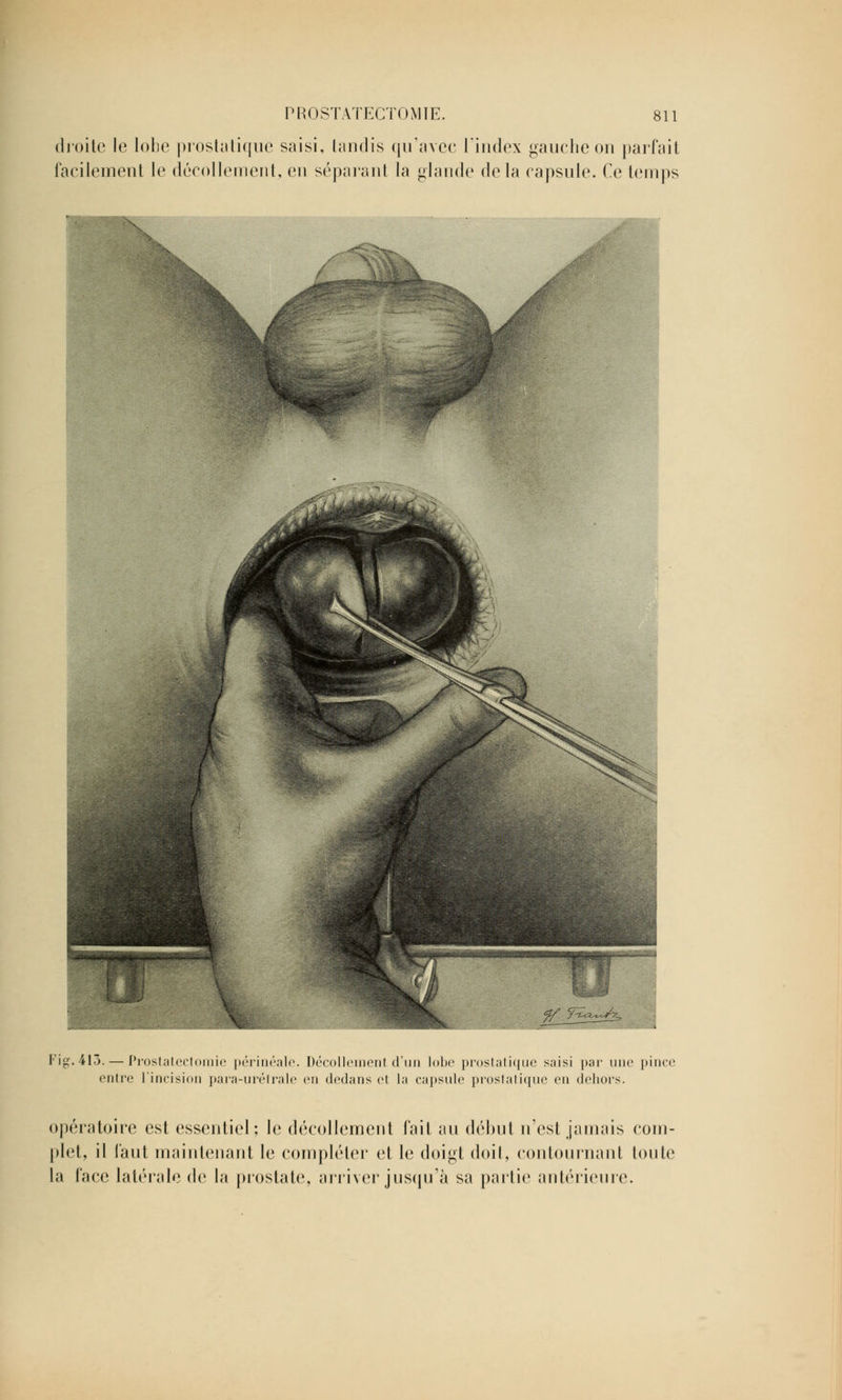 droite le lobe prostatique saisi, tandis qu'avec l'index gauche on parfait facilement le décollement, en séparant la glande delà capsule. Ce temps Kig.413. — Prostatectomie périnéale. Décollement d'un lobe prostatique saisi par une pince entre l'incision para-urétrale en dedans et la capsule prostatique en dehors. opératoire est essentiel; le décollement fait au début n'est jamais com- plet, il faut maintenant le compléter et le doigt doit, contournant toute la face latérale de la prostate, arriver jusqu'à sa partie antérieure.