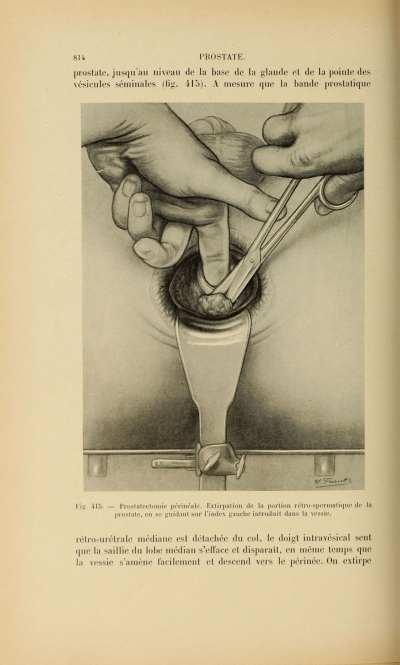 prostate, jusqu'au niveau de la base de la glande et de la pointe des vésicules séminales (fig. 415). A mesure que la bande prostatique I jo Ji5, — Prostatectomie périnéale. Extirpation de la portion rétro-spermatique <le la prostate, en se guidanl sur l'index gauche introduit dans la vessie. rélro-urétrale médiane est détachée du col, le doigt intravésical sent que la saillie du lobe médian s'efface et disparaît, en même temps que la vessie s'amène facilement et descend vers le périnée. On extirpe