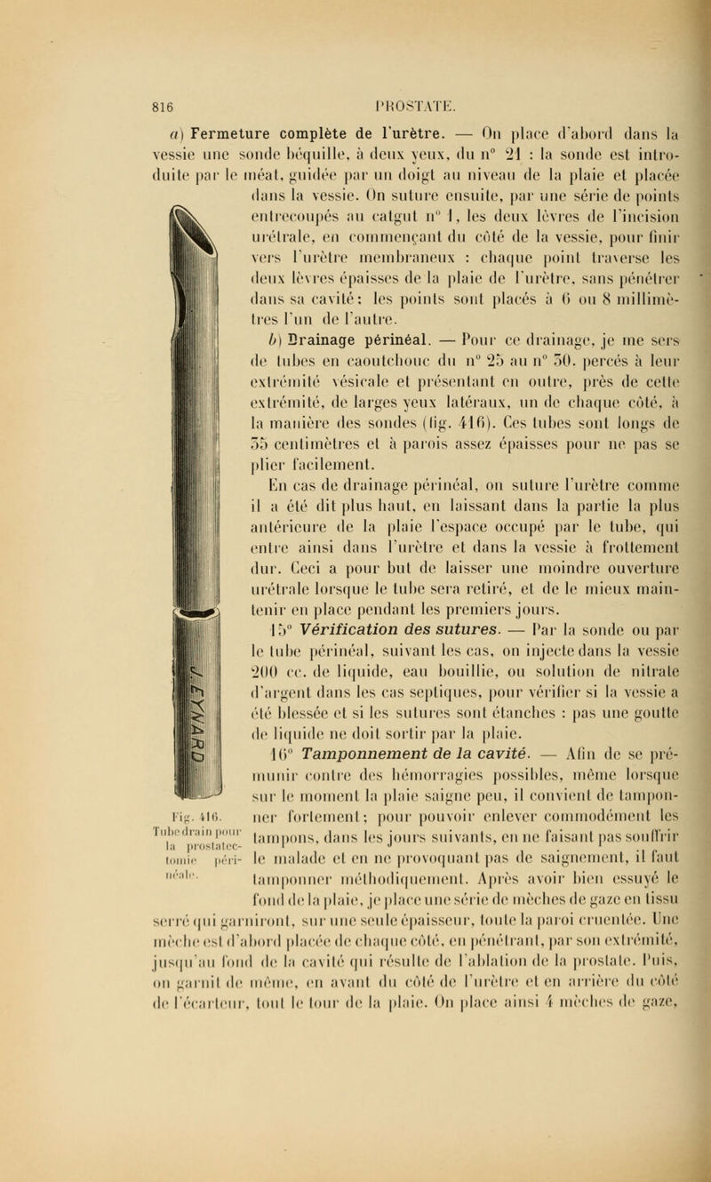 a) Fermeture complète de l'urètre. — On place d'abord dans la vessie une sonde béquille, à deux yeux, du n° 21 : la sonde est intro- duite par le méat, guidée par un doigt au niveau de la plaie et placée dans la vessie. On suture ensuite, par une série de points entrecoupés au catgut n° 1, les deux lèvres de l'incision G»t urélrale, en commençant du côté de la vessie, pour finir vers l'urètre membraneux : chaque point traverse les deux lèvres épaisses de la plaie de l'urètre, sans pénétrer dans sa cavité; les points sont placés à 6 ou 8 millimè- tres l'un de l'autre. b) Drainage périnéal. — Pour ce drainage, je me sers de tubes en caoutchouc du n° 25 au n° 50. percés à leur extrémité vésicale et présentant en outre, près de cette extrémité, de larges yeux latéraux, un de chaque côté, à la manière des sondes (fig. 416). Ces tubes sont longs de 35 centimètres et à parois assez épaisses pour ne pas se plier facilement. En cas de drainage périnéal, on suture l'urètre comme il a été dit plus haut, en laissant dans la partie la plus antérieure de la plaie l'espace occupé par le tube, qui entre ainsi dans l'urètre et dans la vessie à frottement dur. Ceci a pour but de laisser une moindre ouverture urétrale lorsque le tube sera retiré, et de le mieux main- tenir en place pendant les premiers jours. 15° Vérification des sutures. — Par la sonde ou par le tube périnéal, suivant les cas, on injecte dans la vessie 200 ce. de liquide, eau bouillie, ou solution de nitrate d'argent dans les cas sepliques, pour vérifier si la vessie a été blessée et si les sutures sont étanches : pas une goutte de liquide ne doit sortir par la plaie. 16° Tamponnement de la cavité. — Afin de se pré- munir contre des hémorragies possibles, même lorsque sur le moment la plaie saigne peu, il convient de tainpon- Fig. 416. ner fortement; pour pouvoir enlever commodément les i,imIi; , tampons, dans les jours suivants, en ne faisant pas souffrir l,i prostatec- ' J r tomie péri- le malade et en ne provoquant pas de saignement, il huit r;i|r tamponner méthodiquement. Après avoir bien essuyé le fond de la plaie, je place une série de mèches de gaze en tissu serré qui garniront, sur une seule épaisseur, toute la paroi cruentée. Une mèche est d'abord placée de chaque côté, en pénétrant, par son extrémité, jusqu'au fond de la cavité qui résulte de l'ablation de la prostate. Puis, on garnit de même, en avanl du côté de l'urètre et en arrière du côté de l'écarteur, toul le tour de la plaie. On place ainsi 4 mèclies de gaze,