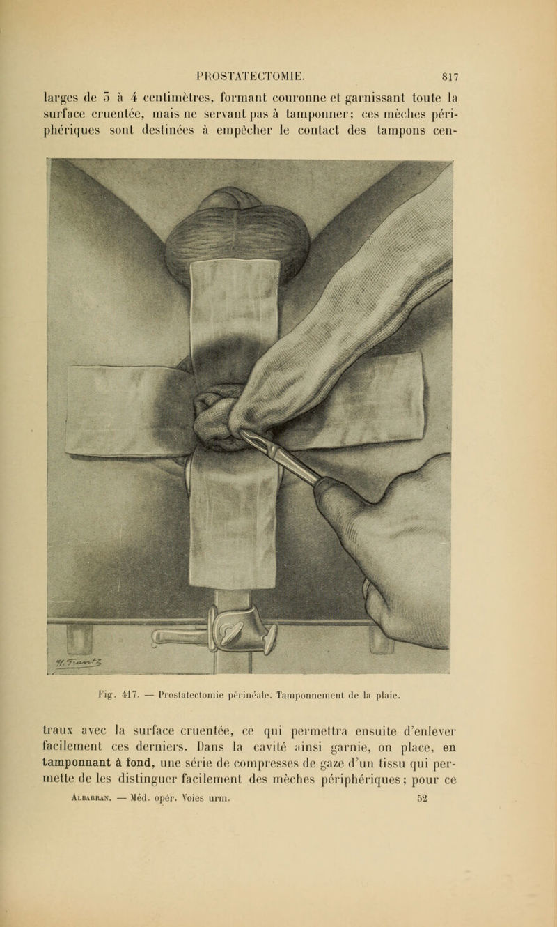 larges de 5 à 4 centimètres, formant couronne et garnissant toute la surface eruentée, mais ne servant pas à tamponner; ces mèches péri- phériques sont destinées à empêcher le contact des tampons cen- Fig. 417. — Proslatectomie périnéale. Tamponnement de la plaie. traux avec la surface eruentée, ce qui permettra ensuite d'enlever facilement ces derniers. Dans la cavité jiinsi garnie, on place, en tamponnant à fond, une série de compresses de gaze d'un tissu qui per- mette de les distinguer facilement des mèches périphériques; pour ce Aluauran. — Méd. opér. Voies urin. 52