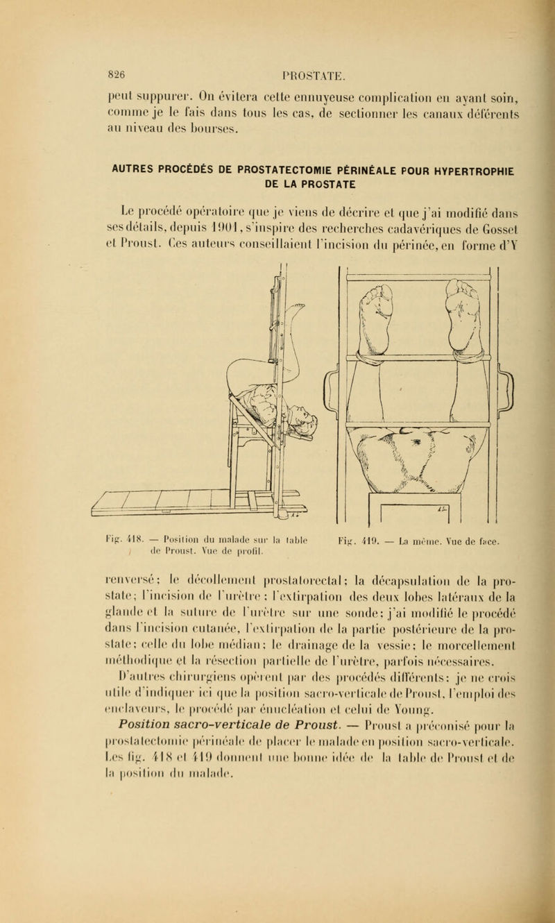 peut suppurer. On évitera cette ennuyeuse complication en ayant soin, comme je le fais dans tous les cas, de sectionner les canaux déférents au niveau des bourses. AUTRES PROCÉDÉS DE PROSTATECTOMIE PÉRINÉALE POUR HYPERTROPHIE DE LA PROSTATE Le procédé opératoire que je viens de décrire et que j'ai modifié dans ses détails, depuis 1901, s'inspire des recherches cadavériques de Gosset et Proust. Ces auteurs conseillaient l'incision du périnée, en forme d'Y Fig. Ï18. — Position du malade su de Proust. Vue de profil. lnbl( Fi'r. 419. — La même. Vue de hco. renversé; le décollement prostatorectal; la décapsulation de la pro- state; l'incision de l'urètre ; l'extirpation des (hu\ lobes latéraux de la glande et la suture de l'urètre sur une sonde; j'ai modifié le procédé dans l'incision cutanée, l'extirpation de la partie postérieure de la pro- state; celle du lobe médian; le drainage de la vessie; le morcellement méthodique cl la résection partielle de l'urètre, parfois nécessaires. D'autres chirurgiens opèrent par des procédés différents: je ne crois utile d'indiquer ici que la position sacro-verticale de Proust, l'emploi des enclaveurs, le procédé par énucléation el celui de Young. Position sacro-verticale de Proust. — Prousl a préconisé pour la prostatectomie périnéale de placer le malade en position sacro-verticale. Les fig. 118 el il!) donnenl une bonne idée de la table de Prousl e! de la position du malade.