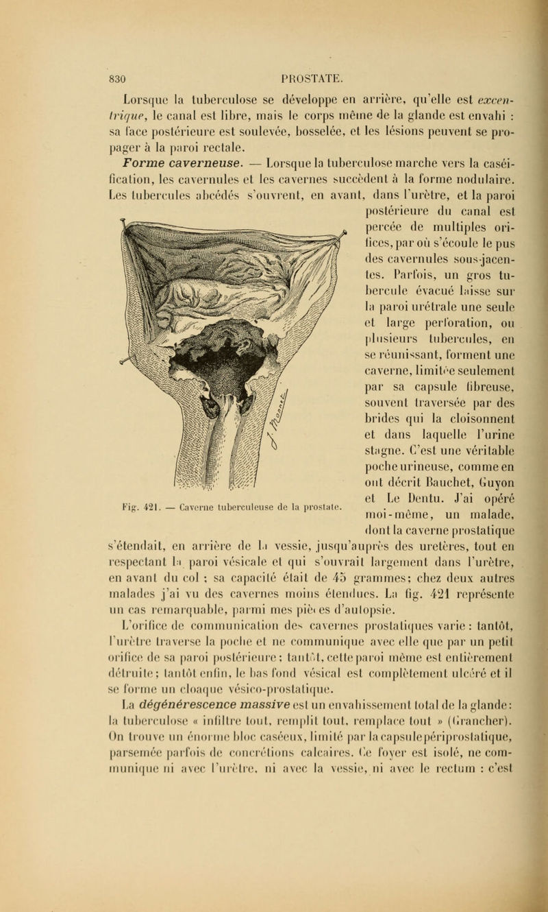 Lorsque la tuberculose se développe en arrière, qu'elle est excen- trique, le canal est libre, mais le corps même de la glande est envahi : sa l'ace postérieure est soulevée, bosselée, et les lésions peuvent se pro- pager à la paroi rectale. Forme caverneuse. — Lorsque la tuberculose marche vers la caséi- fication, les cavernules et les cavernes succèdent à la forme nodulaire. Les tubercules abcédés s'ouvrent, en avant, dans l'urètre, et la paroi postérieure du canal est percée de multiples ori- fices, par où s'écoule le pus des cavernules sous-jacen- tes. Parfois, un gros tu- bercule évacué laisse sur la paroi urétrale une seule et large perforation, ou plusieurs tubercules, en se réunissant, forment une caverne, limitée seulement par sa capsule fibreuse, souvent traversée par des brides qui la cloisonnent et dans laquelle l'urine stagne. C'est une véritable poche urineuse, comme en ont décrit Bauchet, lîuyon et Le Dentu. J'ai opéré moi-même, un malade, dont la caverne prostatique s'étendait, en arrière de la vessie, jusqu'auprès des uretères, tout en respectant l.i paroi vésicale et qui s'ouvrait largement dans l'urètre, en avant du col ; sa capacité était de 45 grammes; chez deux autres malades j'ai vu des cavernes moins étendues. La fig. 421 représente un cas remarquable, parmi mes piè« es d'aulopsie. L'orifice de communication des cavernes prostatiques varie : tantôt, l'urètre traverse la poche et ne communique avec elle que par un petit orifice de sa paroi postérieure; tantôt, cette paroi même est entièrement détruite; tantôt enfin, le bas fond vésical est complètement ulcéré et il se forme un cloaque vésico-prostatique. La dégénérescence massive est un envahissement total de la glande: la tuberculose « infiltre tout, remplit tout, remplace tout » (Grancher). On trouve un énorme bloc caséeux, limité par la capsule périprostatique, parsemée parfois de concrétions calcaires. i)e foyer est isolé, ne com- munique ni avec l'urètre, ni avec la vessie, ni avec le rectum : c'esl Fig. 421. — Caverne tuberculeuse de la prostate.
