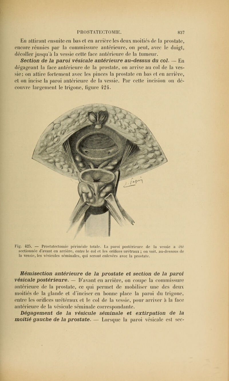 En attirant ensuite en bas et en arrière les deux moitiés de la prostate, encore réunies par la commissure antérieure, on peut, avec le doigt, décoller jusqu'à la vessie cette face antérieure de la tumeur. Section de la paroi vésicale antérieure au-dessus du col. — En dégageant la face antérieure de la prostate, on arrive au col de la ves- sie; on attire fortement avec les pinces la prostate en bas et en arrière, et on incise la paroi antérieure de la vessie. Par cette incision on dé- couvre largement le trigone, figure 424. Fig. 425. — Prostatectomie périnéale totale. La paroi postérieure de la vessie a été sectionnée d'avant en arrière, entre le col et les oritices urétraux ; on voit, au-dessous de la vessie, les vésicules séminales, qui seront enlevées avec la prostate. Hémisection antérieure de la prostate et section de la paroi vésicale postérieure. — D'avant en arrière, on coupe la commissure antérieure de la prostate, ce qui permet de mobiliser une des deux moitiés de la glande et d'inciser en bonne place la paroi du trigone, entre les orifices uiétéraux et le col de la vessie, pour arriver à la face antérieure de la vésicule séminale correspondante. Dégagement de la vésicule séminale et extirpation de la moitié gauche de la prostate. — Lorsque la paroi vésicale est sec-