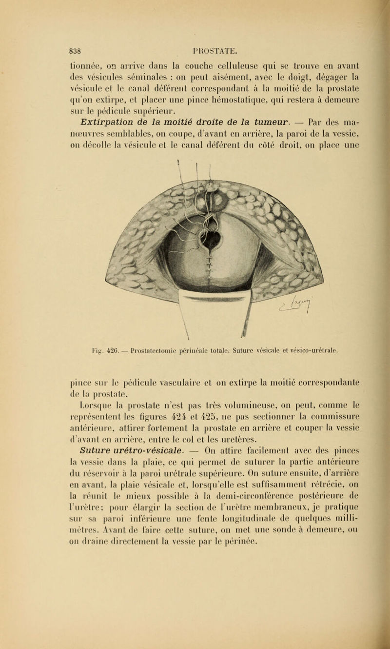 tionnée, on arrive dans la couche celluleuse qui se trouve en avant des vésicules séminales : on peut aisément, avec le doigt, dégager la vésicule et le canal déférent correspondant à la moitié de la prostate qu'on extirpe, et placer une pince hémostatique, qui restera à demeure sur le pédicule supérieur. Extirpation de la moitié droite de la tumeur. — Par des ma- nœuvres semblables, on coupe, d'avant en arrière, la paroi de la vessie, on décolle la vésicule et le canal déférent du côté droit, on place une ljrl ; Fig. 426. — Prostatectomie périnéale totale. Suture vésicale et vésico-urétrale. pince sur le pédicule vasculaire et on extirpe la moitié correspondante de la prostate. Lorsque la prostate n'est pas très volumineuse, on peut, comme le représentent les figures 424 et 425, ne pas sectionner la commissure antérieure, attirer fortement la prostate en arrière et couper la vessie davant en arrière, entre le col et les uretères. Suture urétro-vésicale. — On attire facilement avec des pinces la vessie dans la plaie, ce qui permet de suturer la partie antérieure du réservoir à la paroi urétrale supérieure. On suture ensuite, d'arrière en avant, la plaie vésicale et, lorsqu'elle est suffisamment rétrécie, on la réunit le mieux possible à la demi-circonférence postérieure de l'urètre; pour élargir la section de l'urètre membraneux, je pratique sur sa paroi inférieure une fente longitudinale de quelques milli- mètres. Avant de faire cette suture, on met une sonde à demeure, ou on draine diiectemenl la vessie par le périnée.