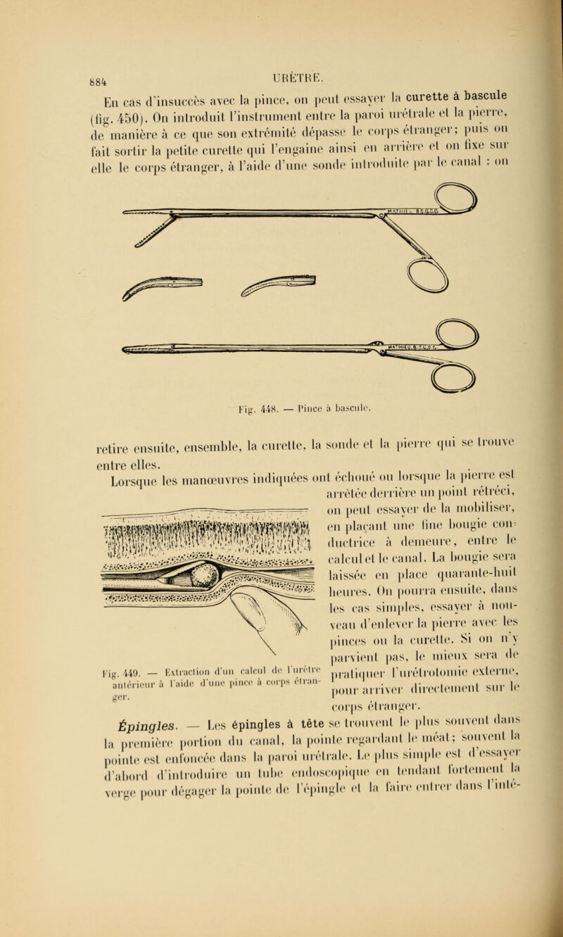 En cas d'insuccès avec la pince, on peut essayer la curette à bascule (fig. 450). On introduit l'instrument entre la paroi urétrale et la pierre, de manière à ce que son extrémité dépasse le corps étranger; puis on fait sortir la petite curette qui l'engaine ainsi en arrière et on fixe sur elle le corps étranger, à l'aide d'une sonde introduite par le canal : on Fig. 448. — Pince à bascule. retire ensuite, ensemble, la curette, la sonde et la pierre qui se trouve entre elles. Lorsque les manœuvres indiquées ont échoué ou lorsque la pierre est arrêtée derrière un point rétréci, ^r^f-=^=^r—, —=^ on peut essayer de la mobiliser, ï^m^ÊWWêÉ&^éM en plaçant lle fine 1)0Ugie CT WphP^ ductrice à demeure' entre le '^^E^ù^^^J^M^^^l calcul et le canal. La bougie sera •f>Jr.t:V^'SWi-^/f^^'^ laissée en place quarante-huit heures. On pourra ensuite, dans les cas simples, essayer à nou- veau d'enlever la pierre avec les pinces ou la curette. Si on n y parvient pas, le mieux sera de Fig. 449. — Extraction d'un calcul de l'urètre pratiquer ['urélrolomio exlerne. anlérieurà l'aide d'une pince à corps étran- V ^ directement snr le corps étranger. Épingles. — Les épingles à tête se trouvent le pins souvent dans |a première portion du canal, la pointe regardant le méat ; souvent la pointe esl enfoncée dans la paroi urétrale. Le pins simple est d'essayer d'abord d'introduire un tube endoscopique en tendant fortement la verge pour dégager la pointe de l'épingle et la faire entrer dans l inté-