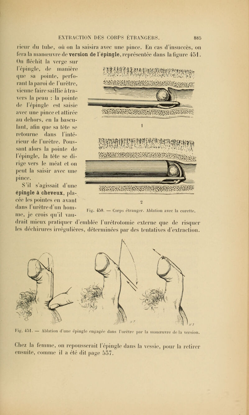 WK^$SÊ0B. rieur du tube, où on la saisira avec une pince. En cas d'insuccès, on fera la manœuvre de version de l'épingle, représentée dans la figure 451. On fléchit la verge sur l'épingle, de manière que sa pointe, perfo- rant la paroi de l'urètre, vienne faire saillie à tra- vers la peau : la pointe de l'épingle est saisie avec une pince et attirée au dehors, en la bascu- lant, afin que sa tête se retourne dans Tinté- rieur de l'urètre. Pous- sant alors la pointe de l'épingle, la tête se di- rige vers le méat et on peut la saisir avec une pince. S'il s'agissait d'une épingle à cheveux, pla- cée les pointes en avant dans l'urètre d'un hom- me, je crois qu'il vau- drait mieux pratiquer d'emblée l'urétrotomie externe que de risquer les déchirures irrégulières, déterminées par des tentatives d'extraction. 1 WïïW^^W^W^^^^S^:ièM^ Fig. 450. — Corps étranger. Ablation avec la curette. Fig. 451. — Ablation d'une épingle engagée dans l'urètre par la manœuvre delà version. Chez là femme, on repousserait l'épingle dans la vessie, pour la retirer ensuite, comme il a été dit page 557.