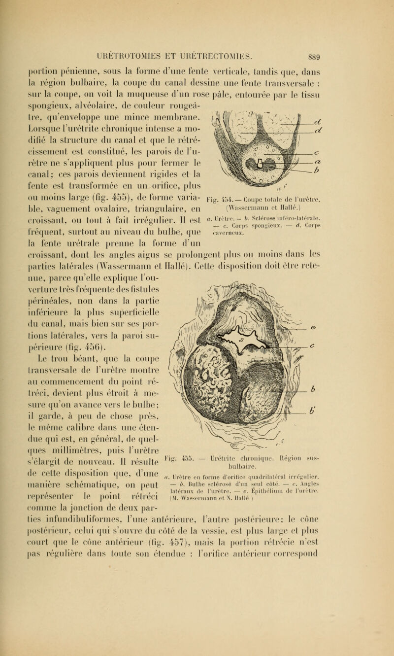 g. i54. — Coupe totale de l'urètre. (Wassermann et. Halle.] Urètre. — b. Sclérose inféro-latérale. — c. Corps spongieux. — d. Corps caverneux. URÉTROTOMIES ET URÉTRECTOMIES. 889 portion pénienne, sous la forme d'une fente verticale, tandis que, dans la région bulbaire, la coupe du canal dessine une fente transversale : sur la coupe, on voit la muqueuse d'un rose pâle, entourée par le tissu spongieux, alvéolaire, de couleur rougeâ- tre, qu'enveloppe une mince membrane. Lorsque l'urétrite chronique intense a mo- difié la structure du canal et que le rétré- cissement est constitué, les parois de l'u- rètre ne s'appliquent plus pour fermer le canal; ces parois deviennent rigides et la fente est transformée en un orifice, plus ou moins large (fig. 455), de forme varia- ble, vaguement ovalaire, triangulaire, en croissant, ou tout à fait irrégulier. Il est fréquent, surtout au niveau du bulbe, que la fente urétrale prenne la forme d'un croissant, dont les angles aigus se prolongent plus ou moins dans les parties latérales (Wassermann et Halle). Cette disposition doit être rete- nue, parce qu'elle explique l'ou- verture très fréquente des fistules périnéales, non dans la partie inférieure la plus superficielle du canal, mais bien sur ses por- tions latérales, vers la paroi su- périeure (fig. 456). Le trou béant, que la coupe transversale de l'urètre montre au commencement du point ré- tréci, devient plus étroit à me- sure qu'on avance vers le bulbe; il garde, à peu de chose près, le même calibre dans une éten- due qui est, en général, de quel- ques millimètres, puis l'urètre s'élargit de nouveau. 11 résulte de cette disposition que, d'une manière schématique, on peut représenter le point rétréci comme la jonction de deux par- ties infundibuliformes, rime antérieure, l'autre postérieure; le cône postérieur, celui qui s'ouvre du côté de la vessie, est plus large et plus court que le cône antérieur (fig. 457), mais la portion rétrécie n est pas régulière dans toute son étendue : l'orifice antérieur correspond Fiff. 455. Urétrite chronique. Région bulbaire. a. Urètre en forme d'orifice quadrilatéral irrégulier. — b. Imlbe sclérosé d'un seul côté. — c. Angles latéraux de l'urètre. — e. Épithélium de l'urètre. (M. Wassermann et >T. Halle )