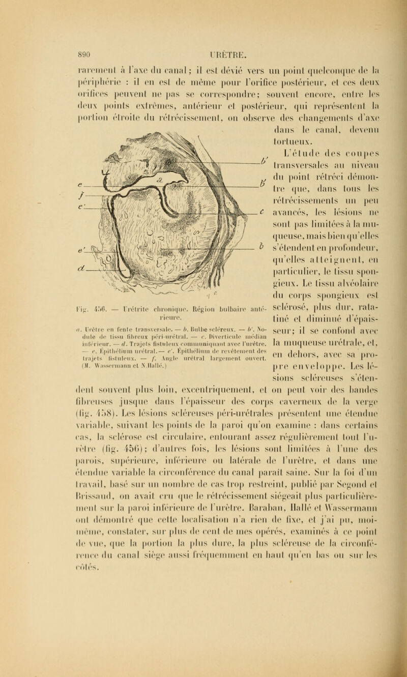 rarement à l'axe du canal; il est dévié vers un point quelconque de la périphérie : il en esl de même pour l'orifice postérieur, et ces deux orifices peuvent ne pas se correspondre; souvent encore, entre les deux points extrêmes, antérieur et postérieur, <jui représentent la portion étroite du rétrécissement, on observe des changements d'axe dans le canal, devenu tortueux. L'étude des cou pes transversales au niveau du point rétréci démon- Ire que, dans Ions les rétrécissements un peu avancés, les lésions ne sont pas limitées à la mu- queuse, mais bien qu'elles £ s'étendent en profondeur, qu'elles al teignent, en particulier, le tissu spon- gieux. Le lissu alvéolaire du corps spongieux esl Fig. 456. — Urétrite chronique. Région bulbaire anté- sclérosé, plus dur, rala- rieure. tiné et diminué d'épais- ii. Urètre on fenJe transversale. — b. Bulbe scléreux. —b'. No- seul il SO Confond ;ivcc diile <!<■ ti>Mi fibreux péri-urétral. — c. Diverticule médian inférieur. — d. Trajets fistuleux communiquant avec l'urètre, la muqilOUSe Ul'Otralo, el, — e. Épilbélium urétral.— e'. Épithélium de revêtement des 1 In.jels Hstuleux. — f. Angl ' ' ' — (M. W'assermann et S.Halle.) urétral largement ouvert. en (leiioi's, avec sa pro- pre enveloppe. Les lé- sions scléreuses s'éten- dent souvent plus loin, excentriquement, et on peut voir des bandes fibreuses jusque dans l'épaisseur des corps caverneux de la verge (iig. f58). Les lésions scléreuses péri-urétrales présentent une étendue variable, suivant les points de la paroi qu'on examine : dans certains cas, la sclérose esl circulaire, entourant assez régulièrement tout l'u- rètre (fig. 456); d'autres Ibis, les lésions sont limitées à l'une des parois, supérieure, inférieure ou latérale de l'urètre, et dans une étendue variable la circonférence du canal parait saine. Sur la foi d'un travail, basé sur un nombre de cas trop restreint, publié par Segond el Brissaud, on avait cru que le rétrécissement siégeait plus particulière- ment sur la paroi inférieure de l'urètre. Baraban, Halle et Wassermann oui démontré <|u<' colle localisation n'a rien de (ixe, et j'ai pu, moi- même, constater, sur plus de cent de mes opérés, examinés à ce poiid de vue, que la portion la plus dure, la plus scléreuse de la circonfé- rence du canal siège aussi fréquemment en haut qu'en bas ou sur les cotés.