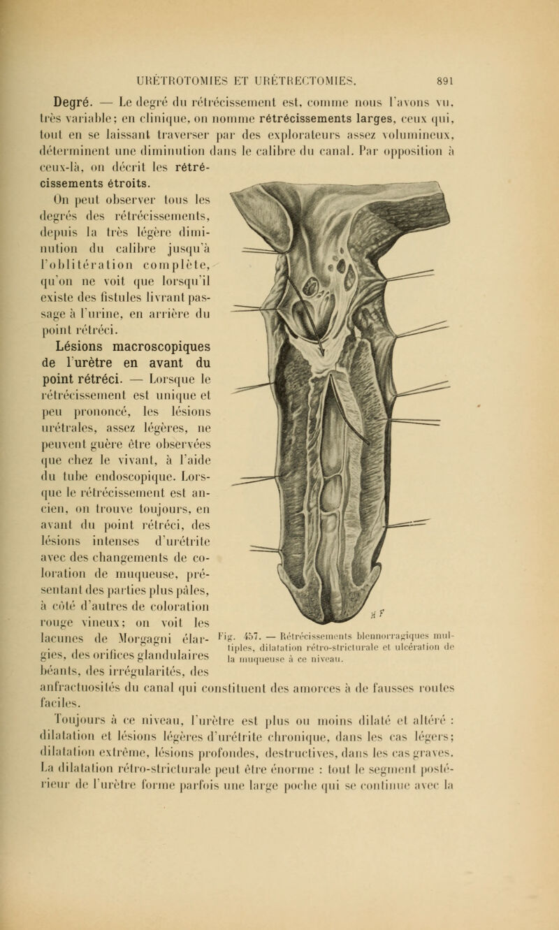 Degré. — Le degré du rétrécissement est, comme nous l'avons vu, très variable; en clinique, on nomme rétrécissements larges, ceux qui, tout en se laissant traverser par des explorateurs assez volumineux, déterminent une diminution dans le calibre du canal. Par opposition à ceux-là, on décrit les rétré- cissements étroits. On peut observer tous les degrés des rétrécissements, depuis la très légère dimi- nution du calibre jusqu'à l'oblitération complète, qu'on ne voit que lorsqu'il existe des fistules livrant pas- sage à l'urine, en arrière du point rétréci. Lésions macroscopiques de Furètre en avant du point rétréci. — Lorsque le rétrécissement est unique et peu prononcé, les lésions urétrales, assez légères, ne peuvent guère être observées que chez le vivant, à l'aide du tube endoscopique. Lors- que le rétrécissement est an- cien, on trouve toujours, en avant du point rétréci, des lésions intenses d'urétrite avec des changements de co- loration de muqueuse, pré- sentant des parties plus pâles, à côté d'autres de coloration rouge vineux; on voit les lacunes de Morgagni élar- gies, des orifices glandulaires béants, des irrégularités, des anfractuosités du canal qui constituent des amorces à de fausses routes faciles. Toujours à ce niveau, furètre est plus ou moins dilaté el altéré : dilatation et lésions légères d'urétrite chronique, dans les cas légers; dilatation extrême, lésions profondes, destructives, dans les cas graves. La dilatation rétro-stricturale peut être énorme : tout le segment posté- rieur de l urètre forme parfois une large poche qui se continue avec la Fig. 457. — Rétrécissements blennorragiques mul- tiples, dilatation rétro-stricturale el ulcération de la muqueuse ;'i ce niveau.