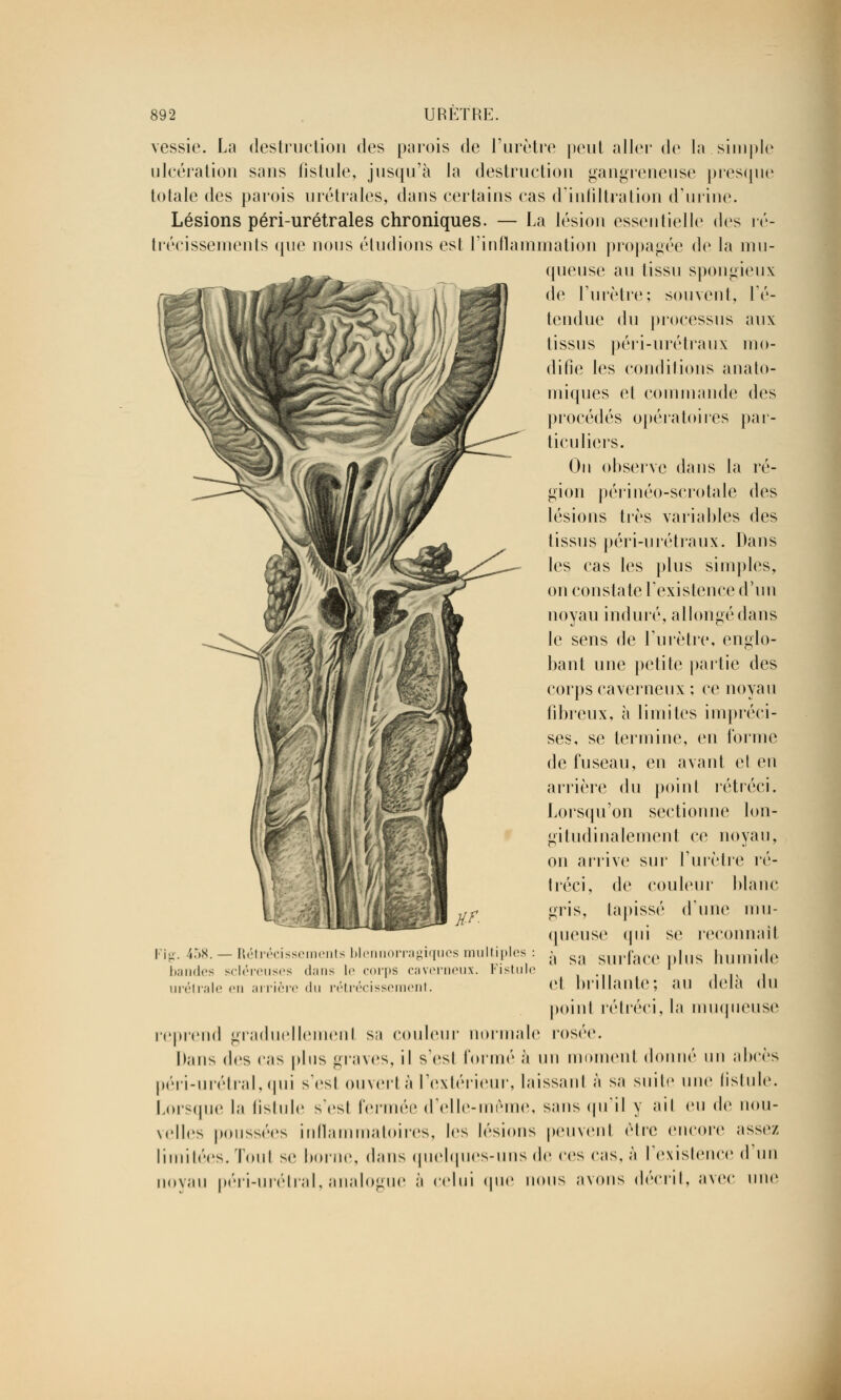 vessie. La destruction des parois de l'urètre peut aller de la simple ulcération sans fistule, jusqu'à la destruction gangreneuse presque totale des parois urétrales, dans certains cas d'infiltration d'urine. Lésions péri-urétrales chroniques. — La lésion essentielle des ré- trécissements que nous éludions est l'inflammation propagée de la mu- queuse au tissu spongieux de l'urètre; souvent, re- tendue du processus aux tissus péri-urétraux mo- difie les conditions anato- miques et commande des procédés opératoires par- ticuliers. On observe dans la ré- gion périnéo-scrotale des lésions très variables des tissus péri-urétraux. Dans les cas les plus simples, on constate l'existence d'un noyau induré, allongé dans le sens de l'urètre, englo- bant une petite partie des corps caverneux ; ce noyau fibreux, à limites impréci- ses, se termine, en forme de fuseau, en avant et en arrière du point rétréci. Lorsqu'on sectionne lon- giludinalement ce noyau, on arrive sur l'urètre ré- tréci, de couleur blanc gris, lapissé d'une mu- queuse qui se reconnaît à sa surface plus humide et brillante; au delà du point rétréci, la muqueuse reprend graduellement sa couleur normale rosée. Dans des cas plus graves, il s'est formé à un moment donné un abcès péri-urétral,qui s'esl ouvert à l'extérieur, laissant à sa suite une fistule. Lorsque la fistule s'est fermée d'elle-même, sans qu'il y ait eu de nou- velles poussées inflammatoires, les lésions peuvent être encore assez limitées. Tout se borne, dans quelques-uns de ces cas, à l'existence d'un noyau péri-urétral,analogue à celui que nous avons décrit, avec une Fig. 458. — Rétrécissements blennorragiqucs multiple bandes scléreuses dans le corps caverneux. Fisti urélrale en arrière du rétrécissement.