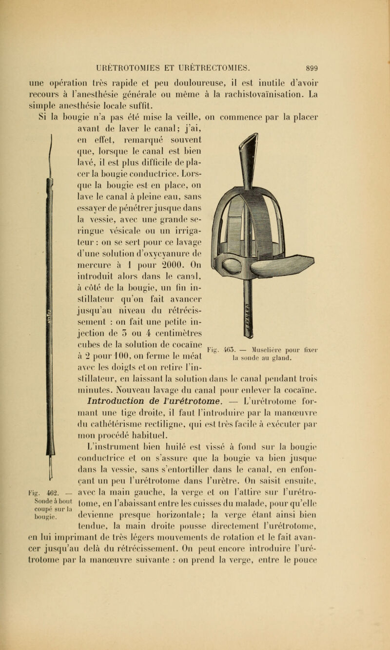 une opération très rapide et peu douloureuse, il est inutile d'avoir recours à l'anesthésie générale ou même à la rachistovaïnisation. La simple anesthésie locale suffit. Si la bougie n'a pas été mise la veille, on commence par la placer avant de laver le canal; j'ai, en effet, remarqué souvent que, lorsque le canal est bien lavé, il est plus difficile de pla- cer la bougie conductrice. Lors- que la bougie est en place, on lave le canal à pleine eau, sans essayer de pénétrer jusque dans la vessie, avec une grande se- ringue vésicale ou un irriga- teur : on se sert pour ce lavage d'une solution d'oxycyanure de mercure à 1 pour 2000. On introduit alors dans le canal, à côté de la bougie, un fin in- stillateur qu'on fait avancer jusqu'au niveau du rétrécis- sement : on fait une petite in- jection de o ou 4 centimètres cubes de la solution de cocaïne à 2 pour J 00, on ferme le méat avec les doigts et on retire l'in- stillateur, en laissant la solution dans le canal pendant trois minutes. Nouveau lavage du canal pour enlever la cocaïne. Introduction de l'urétrotome. — L'urétrotome for- mant une tige droite, il faut l'introduire par la manœuvre du cathétérisme rectiligne, qui est très facile à exécuter par mon procédé habituel. L'instrument bien huilé est vissé à fond sur la bougie conductrice et on s'assure que la bougie va bien jusque dans la vessie, sans s'entortiller dans le canal, en enfon- çant un peu l'urétrotome dans l'urètre. On saisit ensuite, avec la main gauche, la verge et on l'attire sur l'urétro- tome, en l'abaissant entre les cuisses du malade, pour qu'elle devienne presque horizontale; la verge étant ainsi bien tendue, la main droite pousse directement l'urétrotome, en lui imprimant de très légers mouvements de rotation et le fait avan- cer jusqu'au delà du rétrécissement. On peut encore introduire l'uré- trotome par la manœuvre suivante : on prend la verge, entre le pouce fi Fil i63. — Muselière pour fixer la soude au gland. Fig. 462. — Sonde à bout coupô sur la bougie.