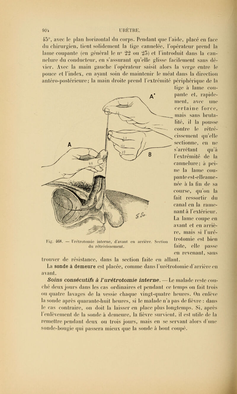 45°, avec le plan horizontal du corps. Pendant que l'aide, placé en face du chirurgien, tient solidement la tige cannelée, l'opérateur prend la lame coupante (en général le n° 22 ou 25) et l'introduit dans la can- nelure du conducteur, en s'assurant qu'elle glisse facilement sans dé- vier. Avec la main gauche l'opérateur saisit alors la verge entre le pouce et l'index, en ayant soin de maintenir le méat dans la direction antéro-postérieure; la main droite prend l'extrémité périphérique de la tige à lame cou- pante et, rapide- ment, avec une certaine force, mais sans bruta- lité, il la pousse contre le rétré- cissement qu'elle sectionne, en ne s'arrètant qu'à l'extrémité de la cannelure; à pei- ne la lame cou- pante est-elleame- née à la fin de sa course, qu'on la fait ressortir du canal en la rame- nant à l'extérieur. La lame coupe en avant et en arriè- re, mais si l'uré- trotomie est bien faite, elle passe en revenant, sans trouver de résistance, dans la section faite on allant. La sonde à demeure est placée, comme dans l'urétrotomie d'arrière en avant. Soins consécutifs à l'urétrotomie interne. — Le malade reste cou- ché deux jours dans les cas ordinaires et pendant ce temps on fait trois ou quatre lavages de la vessie chaque vingt-quatre heures. Ou enlève la sonde après quarante-huit heures, si h; malade n'a pas de fièvre : dans le cas contraire, on doit la laisser en place plus longtemps. Si, après l'enlèvement de la sonde à demeure, la lièvre survient, il est utile de la remettre pendant deux ou trois jouis, mais en se servanl alors d'une sonde-bougie qui passera mieux que la sonde à bout coupé. Fig. -468. — llrétrotomie interne, d'avant en arrière. Section du rétrécissement.