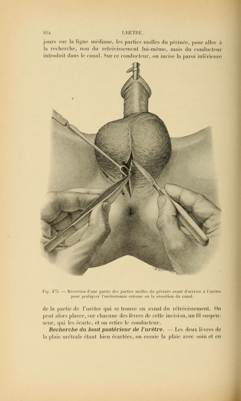 91k URÈTÏŒ. jours sur la ligue médiane, les parties molles du périnée, pour aller à la recherche, non du rétrécissement lui-même, mais du conducteur introduit dans le canal. Sur ce conducteur, on incise la paroi inférieure Fig. 475. — Résection d'une partie tirs parties molles du périnée ayant d'arriver à l'urét] pour pratiquer l'urétrotomie externe ou La résection du canal. delà pailic de l'urètre qui se trouve en avnat du rétrécissement. On peut alors placer, sur chacune des lèvres de celle incision, un (il snspen- seur, (|ni les écarte, et on relire le conducteur. Recherche du bout postérieur de l'urètre. — Les deux lèvres de la plaie urétrale étant bien écartées, on essuie la plaie avec soin et en