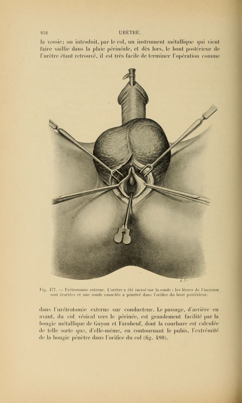 la vessie; on introduit, par le col, un instrument métallique qui vient l'aire saillie dans la plaie périnéale, et dès lors, le bout postérieur de l'urètre étant retrouvé, il est très facile de terminer l'opération comme Kig. î77. — Urétrotomie externe. L'urètre a été incisésur lasonde; les lèvres de l'incisio sonl écartées ci une sonde cannelée ;i pénétré dans l'orifice du boul postérieur. dans l'urétrotomie externe sur conducteur. Le passage, d'arrière eu avant, du col vésical vers le périnée, est grandement facilité par la bougie métallique de Guyon et Farabeuf, dont la courbure est calculée de telle sorte que, d'elle-même, en contournant le pubis, l'extrémité de la bougie pénètre dans l'orifice du col (fig. 180).