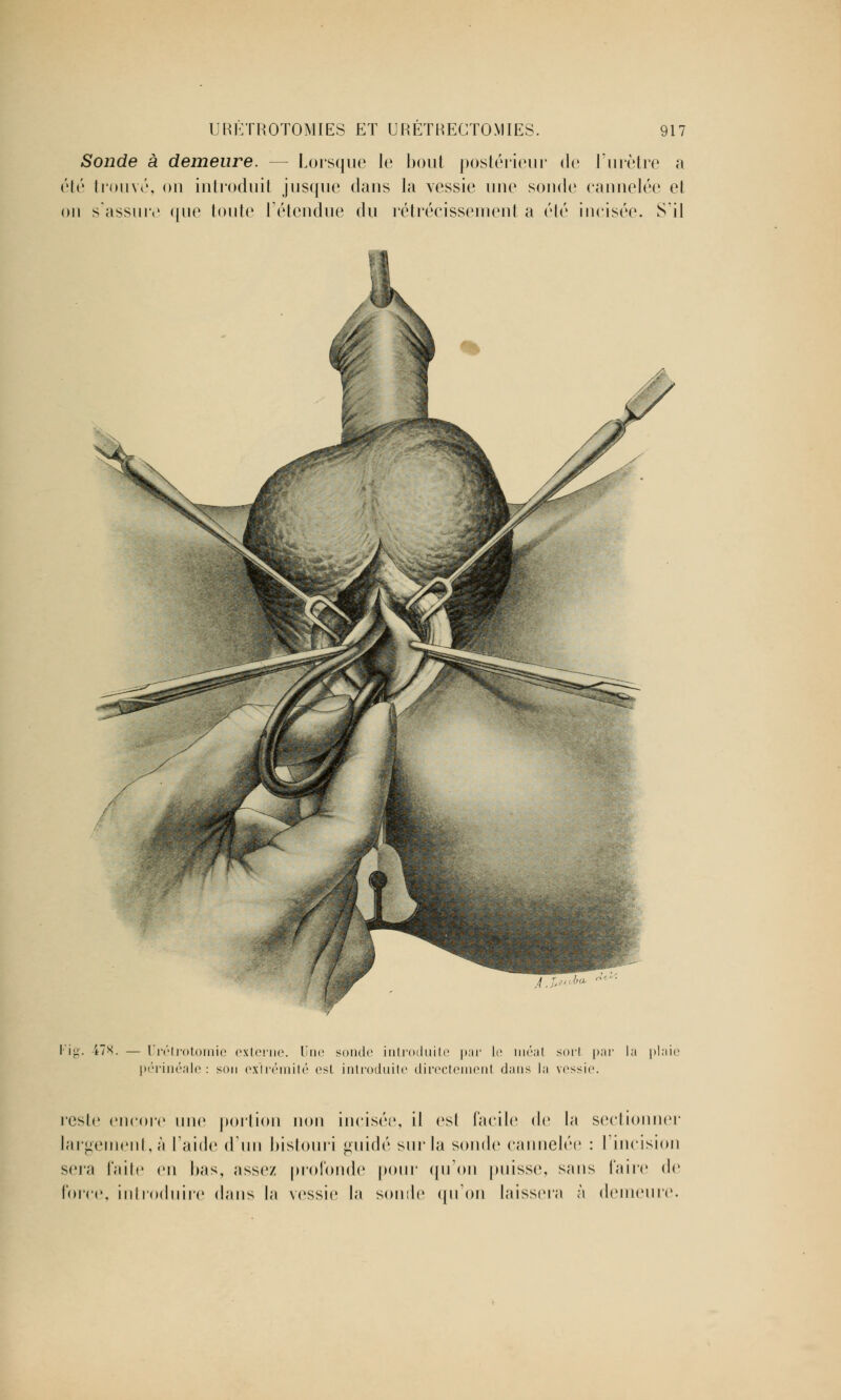 Sonde à demeure. — Lorsque le bout postérieur de l'urètre a été trouvé, on introduit jusque dans la vessie une sonde cannelée et on s'assure que tonte l'étendue du rétrécissement a élé incisée. S'il vu 78. — Urétrotomie externe. Une sonde introduite par le méat sort par la plaie périnéale : son extrémité est introduite directement dans la vessie. reste encore une portion non incisée, il est facile de la sectionner largement, à l'aide d'un bistouri guidé sur la sonde cannelée : l'incision sera faite en bas, assez profonde pour qu'on puisse, sans faire de force, introduire dans la vessie la sonde qu'on laissera à démettre.