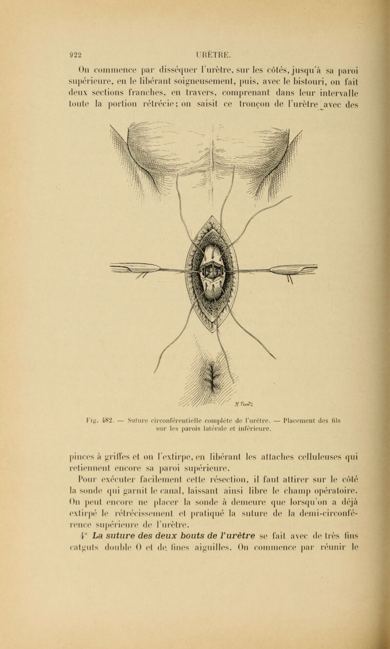 On commence par disséquer l'urètre, sur les côtés, jusqu'à sa paroi supérieure, en le libérant soigneusement, puis, avec le bistouri, on fait deux sections franches, en travers, comprenant dans leur intervalle toute la portion rétrécie; on saisit ce tronçon de l'urètre jnec des Jf. TutfL Fig. i82. — Siiiuiv circonférentièlle complète de l'urètre. — Placement des fils sur les parois latérale et inférieure. pinces à griffes et on l'extirpe, en libérant les attaches celluleuses qui retiennent encore sa paroi supérieure. Pour exécuter facilement celle résection, il faut attirer sur le côté la sonde qui garnit le canal, laissant ainsi libre le champ opératoire. On peut encore ne pincer la sonde à demeure que lorsqu'on a déjà extirpé le rétrécissement et pratiqué la suture de la demi-circonfé- rence supérieure de l'urètre. I La suture des deux bouts de l'urètre se fait avec délies lins catguts double 0 et de lines aiguilles. On commence par réunir le