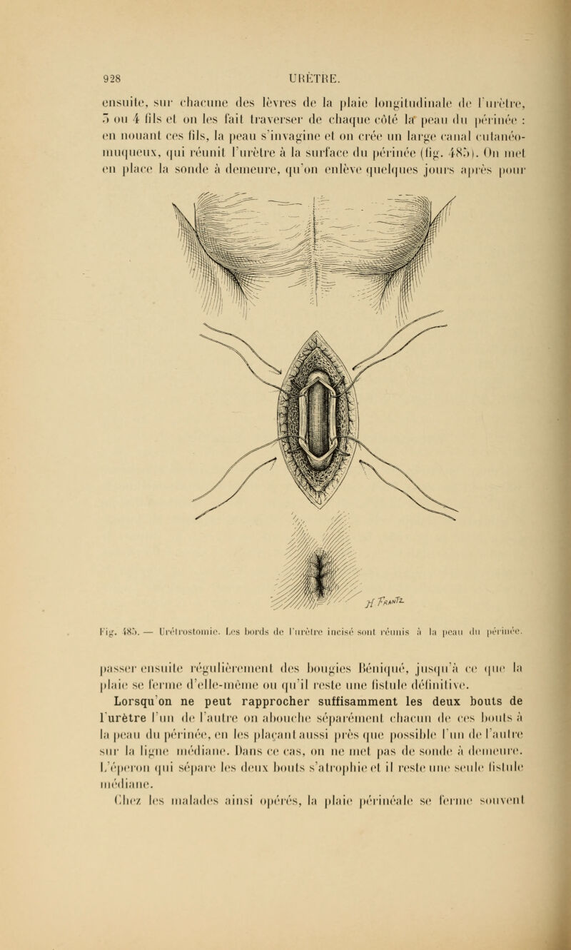 ensuite, sur chacune des lèvres de la plaie longitudinale de l'urètre, 3 ou 4 fils et on les fait traverser de chaque côté la peau du périnée : en nouant ces fils, la peau s'imagine et on crée un large canal cutanéo- muqueux, qui réunit l'urètre à la surface du périnée (fig. 485). On met en place la sonde à demeure, qu'on enlève quelques jours après pour Fïg. 485. — Urétrostomie. Les bords do l'urètre incisé sont réunis à la peau du périnée passer ensuite régulièrement des bougies Béniqué, jusqu'à ce que la plaie se ferme d'elle-même ou qu'il reste une fistule définitive. Lorsqu'on ne peut rapprocher suffisamment les deux bouts de l'urètre l'un de l'autre on abouche séparément chacun de ces bonis à la peau du périnée, en les plaçant aussi près (pie possible l'un de l'autre sur la ligne médiane. Dans ce cas, on ne met pas de sonde à demeure. L'éperon qui sépare les deux bouts s'atrophie et il reste une seule fistule médiane. (liiez les malades ainsi opérés, la plaie périnéale se ferme souvent