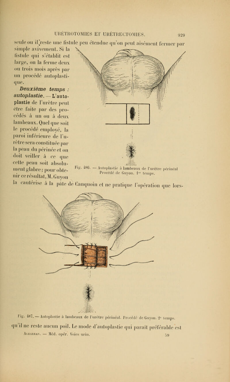 seule ou irreste une fistule peu étendue qu'on peut aisément fermer par simple avivement. Si la fistule qui s'établit est large, on la ferme deux ou trois mois après par un procédé autoplasti- que. Deuxième temps : autoplastie. — L'auto- plastie de l'urètre peut être faite par des pro- cédés à un ou à deux lambeaux. Quel que soit le procédé employé, la paroi inférieure de l'u- rètre sera constituée par la peau du périnée et on doit veiller à ce que cette peau soit absolu- ment glabre ; pour obte- nir ce résultat, M. Guyon la cautérise à la pâte de Canquoin et ne pratique l'opération que lors- Fï&. 486. Autoplastie à lambeaux de l'urètre périnéal Procédé de Guyon. 1er temps. Fig. £87. — Autoplastie à lambeaux de l'urètre périnéal. Procédé de Guyon. 2e lemps. qu'il ne reste aucun poil. Le mode d'autoplastie qui parait préférable est Albarrax. — Méd. opér. Voies uni!. 59