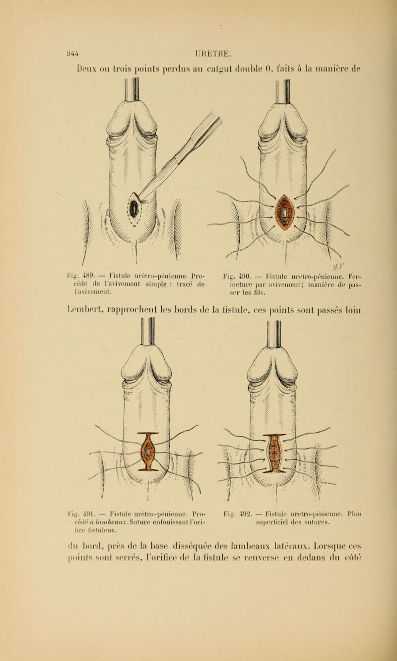 Deux ou trois points perdus au catgut double 0, faits à la manière de Fig. 4<S9. — Fistule urétro-pénieime. Pro- cédé de l'avivement simple : tracé de l'avivement. Fig-. 490. — Fistule urétro-pénienne. Fer- meture par a vivement; manière de pas- ser les fils. Lembert, rapprochent les bords de la fistule, ees points sont passés loin II! Fig, i'.H. — Fistule urétro-pénienne. Pro- cédé  lambeaux. Suture enfouissant l'ori- lice fistuleux. Fig. 492. — Fistule urétro-péniej superficiel des sutures. <lu bord, près de In base disséquée des lambeaux latéraux. Lorsqui points sont serrés, l'orifice <l<i In fistule se renverse eu dedans du PL ! ces côté