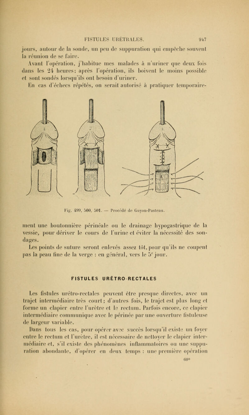 jours, autour de la sonde, un peu de suppuration qui empêche souvent la réunion de se faire. Avant l'opération, j'habitue mes malades à n'uriner que deux Fois dans les 24 heures; après l'opération, ils boivent le moins possible et sont sondés lorsqu'ils ont besoin d'uriner. En cas d'échecs répétés, on serait autorisé à pratiquer temporaire- Fig. 499, 500, 501. — Procédé de Guyon-Pasteau. ment une boutonnière périnéale ou le drainage hypogastrique de la vessie, pour dériver le cours de l'urine et éviter la nécessité des son- dages. Les points de suture seront enlevés assez tôt, pour qu'ils ne coupent pas la peau fine de la verge : en général, vers le 5e jour. FISTULES URÉTRO RECTALES Les fistules urétro-rectales peuvent être presque directes, avec un trajet intermédiaire très court; d'autres fois, le trajet est plus long el forme un clapier entre l'urètre et le rectum. Parfois encore, ce clapier intermédiaire communique avec le périnée par une ouverture fistuleuse de largeur variable. Dans tons les cas, pour opérer avec succès lorsqu'il existe un foyer entre le rectum et l'urètre, il est nécessaire de nettoyer le clapier inter- médiaire et, s'il existe des phénomènes inflammatoires ou une suppu- ration abondante, d'opérer en deux temps : une première opération 60*