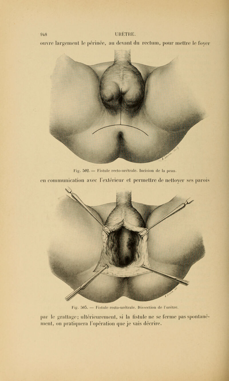 ouvre largement le périnée, au devant du rectum, pour mettre le foyer Fig. 502.— Fistule recto-urétrale. Incision de la peau. en communication avec l'extérieur et permettre de nettoyer ses parois Fig. 503. — Fistule recto-urétrale. Dissection de l'urètre. par le grattage; ultérieurement, si la fistule ne se ferme pas spontané- ment, on pratiquera l'opération que je vais décrire.