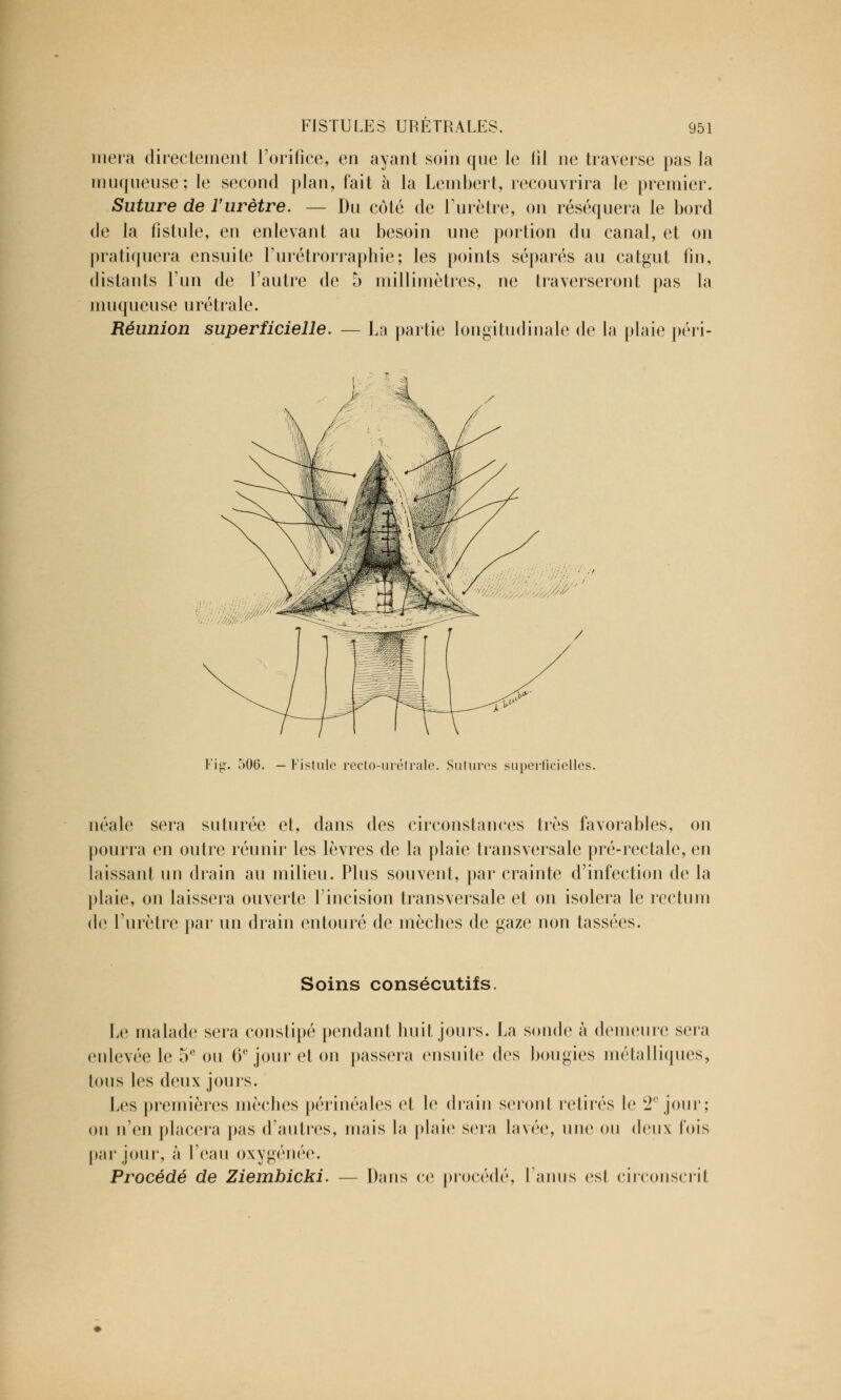 niera directement l'orifice, en ayant soin que le fil ne traverse pas la muqueuse; le second plan, fait à la Lembert, recouvrira le premier. Suture de l'urètre. — Du côté de l'urètre, on réséquera le bord de la fistule, en enlevant au besoin une portion du canal, et on pratiquera ensuite l'urétrorraphie; les points séparés au catgut fin, distants l'un de l'autre de 5 millimètres, ne traverseront pas la muqueuse urétrale. Réunion superficielle. — La partie longitudinale de la plaie péri- Fig. 506. — Fistule recto-urétrale. Sutures superficielles. néale sera suturée et, dans des circonstances très favorables, on pourra en outre réunir les lèvres de la plaie transversale pré-rectale, en laissant un drain au milieu. Plus souvent, par crainte d'infection de la plaie, on laissera ouverte l'incision transversale et on isolera le rectum de l'urètre par un drain entouré de mèches de gaze non tassées. Soins consécutifs. Le malade sera constipé pendant huit jours. La sonde à demeure sera enlevée le 5° ou 6e jour et on passera ensuite des bougies métalliques, tous les deux jours. Les premières mèches périnéales et le drain seront retirés le 2e jour; on n'en placera pas d'antres, mais la plaie sera lavée, une on deux lois par jour, à l'eau oxygénée. Procédé de Ziembicki. — Dans ce procédé, l'anus esi circonscrit