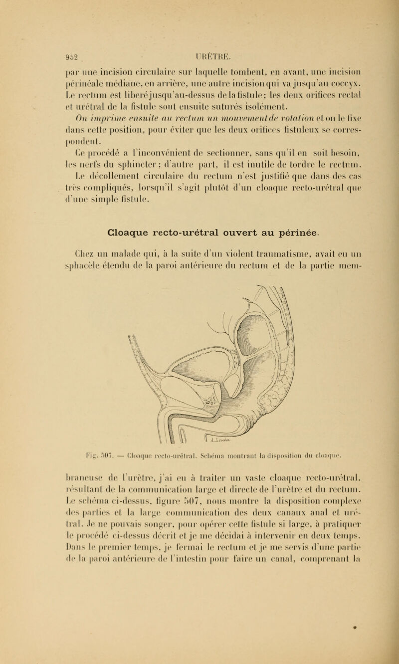 par une incision circulaire sur laquelle tombent, en avant, une incision périnéale médiane, en arrière, une autre incision qui va jusqu'au coccyx. Le rectum est libéré jusqu'au-dessus de la fistule; les deux orifices rectal et urétral de la fistule sont ensuite suturés isolément. On imprime ensuite au rectum un mouvementée rotation et on le fixe dans cette position, pour éviter que les deux orifices fistuleux se corres- pondent. Ce procédé a l'inconvénient de sectionner, sans qu'il en soit besoin, les nerfs du sphincter; d'autre part, il est inutile de tordre le rectum. Le décollement circulaire du rectum n'est justifié que dans des cas très compliqués, lorsqu'il s'agit plutôt d'un cloaque recto-urétral que d'une simple fistule. Cloaque recto-urétral ouvert au périnée. Chez un malade qui, à la suite d'un violent traumatisme, avait eu un sphacèle étendu de la paroi antérieure du rectum et de la partie niein- Mil r Fig. 5(17. — Cloaque recto-urétral. Schéma montrant la disposition du cloaque braneuse de l'urètre, j'ai eu à traiter un vaste cloaque recto-urétral, résultant de la communication large el directe de l'urètre et du rectum. Le schéma ci-dessus, figure 507, nous montre la disposition complexe des parties et la large communication des deux canaux anal et uré- tral. Je ne pouvais songer, pour opérer celle lislule si large, à pratiquer le procédé ci-dessus décril el je nie décidai à intervenir en deux temps. I);ins le premier temps, je fermai le rectum el je me servis (rime partie de la paroi antérieure de l'intestin pour faire un canal, comprenant la