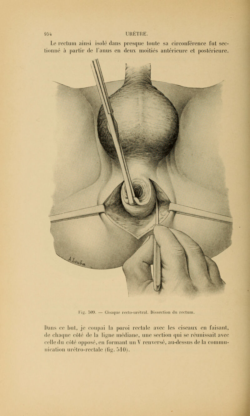 Le rectum ainsi isolé dans presque toute sa circonférence fut sec- tionné à partir de l'anus en deux moitiés antérieure et postérieure. Kig. 509. — Cloaque recto-urétral. Dissection du recttu l);nis ce but, je coupai l;i paroi rectale avec les ciseaux en faisant, de chaque côté de la ligne médiane, une section qui se réunissait avec celledu côté opposé, en formanl un V renversé, au-dessus de la commu- nication urétro-rectale (fig. 510).