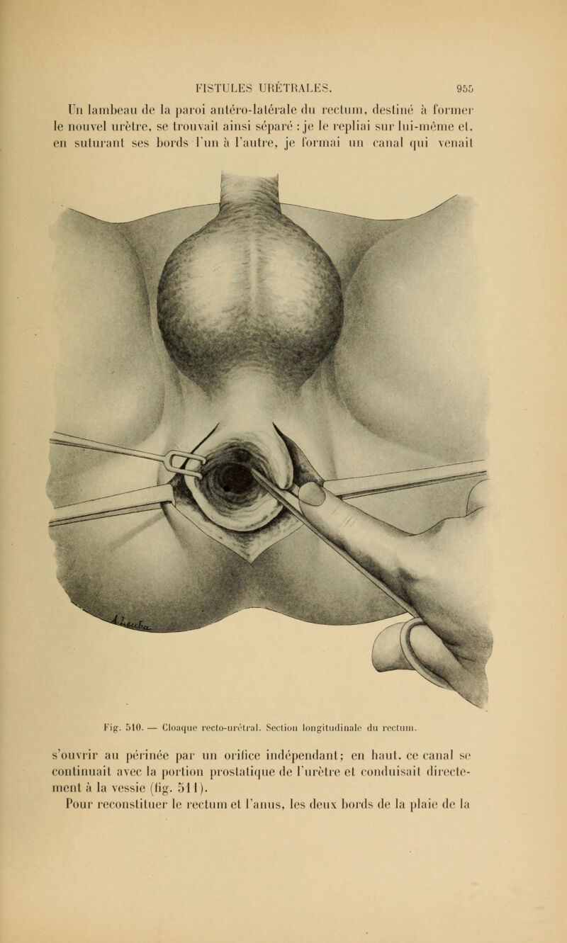 Un lambeau de la paroi antéro-lalérale du rectum, destiné à formel- le nouvel urètre, se trouvait ainsi séparé : je le repliai sur lui-même et, en suturant ses bords l'un à l'autre, je Tonnai un canal qui venait V\g. 510. — Cloaque recto-urétral. Section longitudinale du rectum. s'ouvrir au périnée par un orifice indépendant; en haut, ce canal se continuait avec la portion prostatique de l'urètre et conduisait directe- ment à la vessie (fig. 511 ). Pour reconstituer le rectum et l'anus, les deux bords de la plaie de la