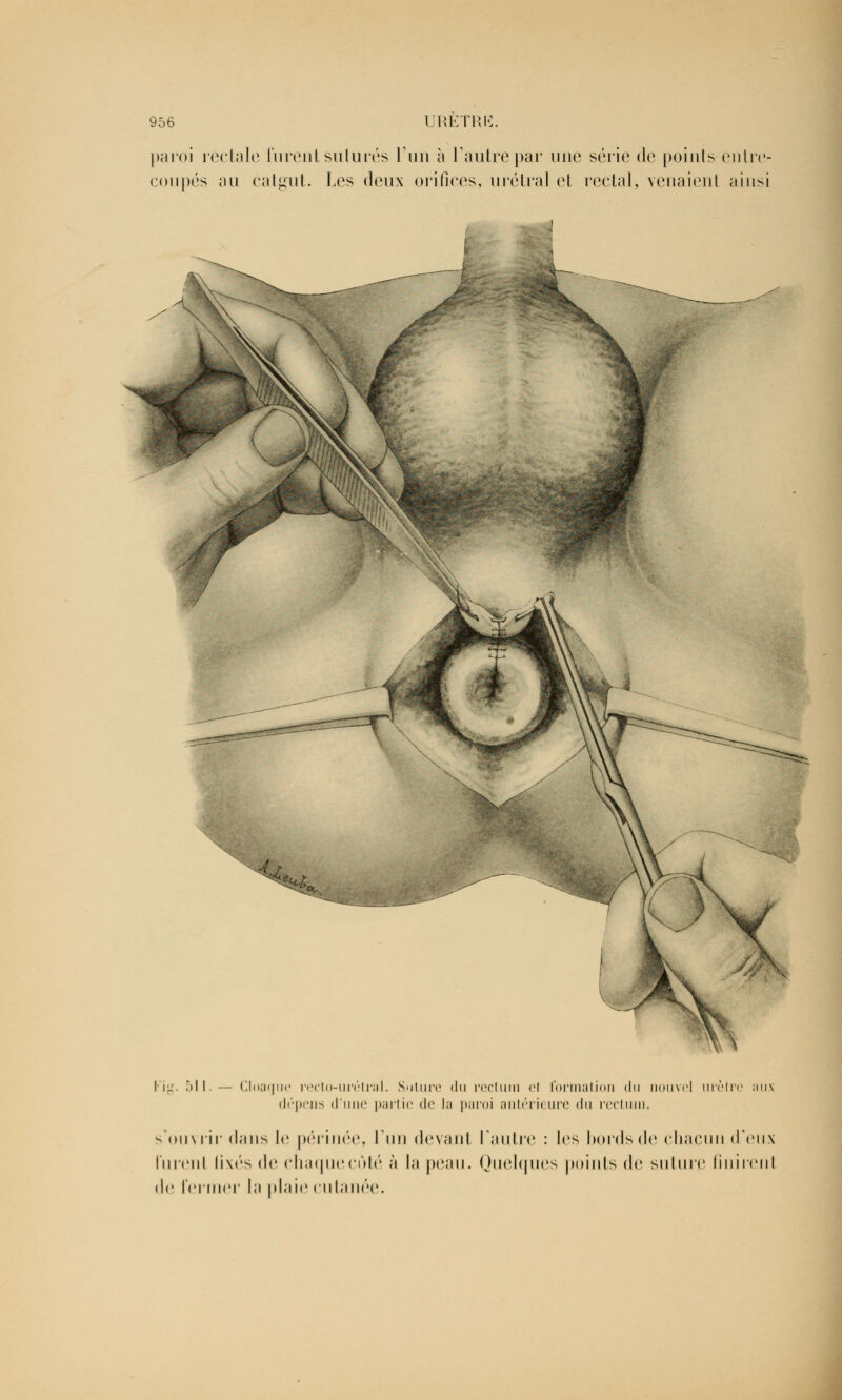 paroi rectale lurent suturés l'un à l'autre par une série de points entre- coupés au catgut. Les deux orifices, urétral et rectal, venaient ainsi ^ l r_. 511.— Cloaque recto-urétral. Suture «lu rectum el formation du nouvel urètre aux dépens d'une partie de la paroi antérieure du rectum. v <>ii\ rir dans le périnée, l'un devant l'autre : les bords de chacun d'eux lurent fixés de chaquecôté à la peau. Quelques points de suture finirent de fermer la plaie cutanée.