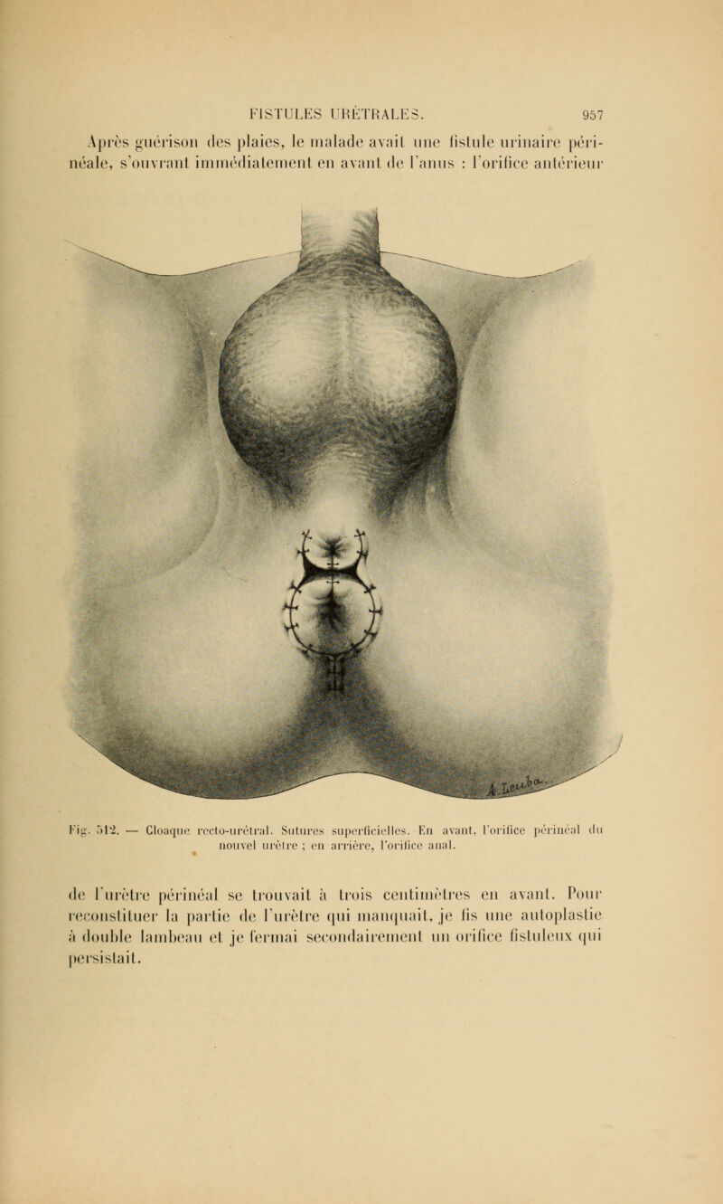 Après guérison des plaies, le malade avait une fistule urinaire péri- néale, s'ouvrant immédiatement en avant de l'anus : l'orifice antérieur lu Cloaque recto-urétral. Sutures superficielles. En avant, l'orifice périnéal du nouvel urètre ; en arrière, l'orifice anal. de l'urètre périnéal se trouvait à trois centimètres en avant. Pour reconstituer la partie de l'urètre qui manquait, je lis une autoplastie à double lambeau et je fermai secondairement un orifice fistuleux <|iii persistait.