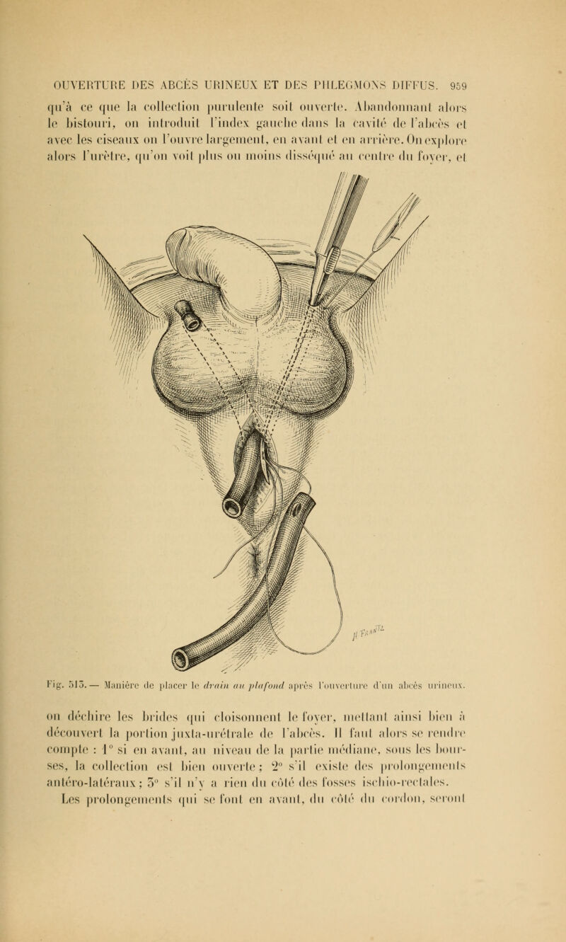 qu'à ce que la collection purulente soit ouverte. Abandonnant alors le bistouri, on introduit l'index gauche dans la cavité de l'abcès et avec les ciseaux on l'ouvre largement, en avant et en arrière. On explore alors l'urètre, qu'on voit plus ou moins disséqué au centre du foyer, el jlW11 Fig. 513.— Manière de placer le drain ou plafond après l'ouverture d'un abcès urineux. on déchire les brides qui cloisonnent le loyer, mettant ainsi bien à découvert la portion juxta-urétrale de l'abcès. Il faut alors se rendre compte : 1 si en avant, au niveau de la partie médiane, sous les bour- ses, la collection est bien ouverte; 2° s'il existe des prolongements antéro-latéraux ; 5° s'il n'y a rien du côté des Fosses ischio-rectales. Les prolongements qui se font en avant, du côté du cordon, seronl