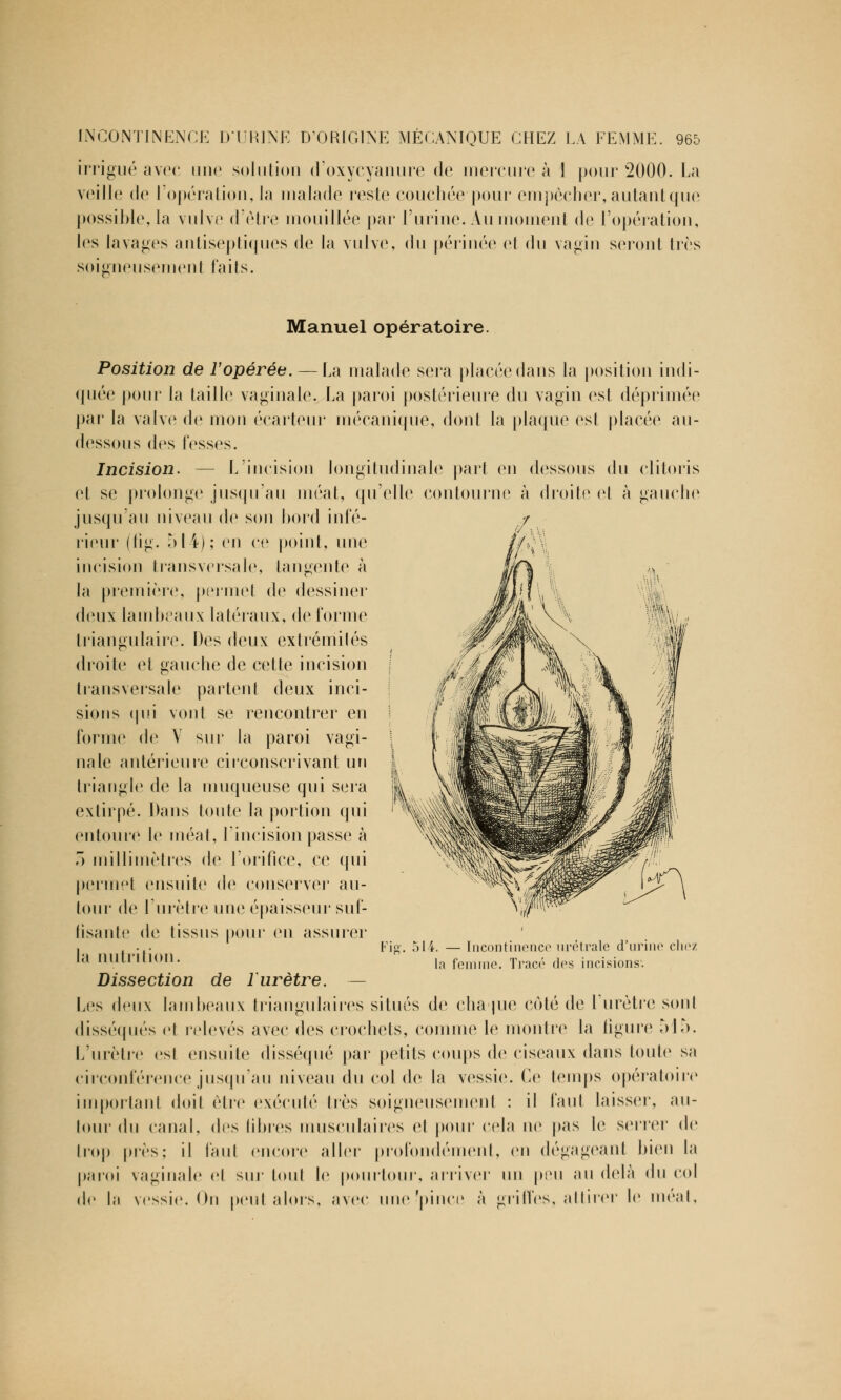 irrigué avec une solution d'oxycyanure de mercure à 1 pour 2000. La veille de l'opération, la malade reste couchée pour empêcher, autant que possible, la vulve d'être mouillée par l'urine. Au moment de l'opération, les lavages antiseptiques de la vulve, du périnée et du vagin seront très soigneusement faits. Manuel opératoire. Position de l'opérée. —La malade sera placée dans la position indi- quée pour la taille vaginale. La paroi postérieure du vagin esl déprimée par la valve de mon écarteur mécanique, dont la plaque esl placée au- dessous des fesses. Incision. — L'incision longitudinale part en dessous du clitoris et se prolonge jusqu'au méat, qu'elle contourne à droite el à gauche jusqu'au niveau de son bord infé- rieur (lig. 51 4) ; en ce point, une incision transversale, tangente à la première, permet de dessiner deux lambeaux latéraux, de forme triangulaire. Des deux extrémités di'oite et gauche de cette incision transversale partent deux inci- sions qui vont se rencontrer en forme de Y sur la paroi vagi- nale antérieure circonscrivant un triangle de la muqueuse qui sera extirpé. Dans toute la portion qui entoure le méat, l'incision passe à ) millimètres de l'orifice, ce qui permet ensuite de conserver au- tour de l'urètre une épaisseur suf- fisante de tissus pour en assurer la nutrition. Dissection de l'urètre. — Les deux lambeaux triangulaires situés de cha |iie coté de l'urètre sont disséqués et relevés avec des crochets, connue le montre la figure 515. L'urètre esl ensuite disséqué par petits coups de ciseaux dans toute sa circonférence jusqu'au niveau du col de la vessie. Ce temps opératoire important doit être exécuté lies soigneusement : il faut laisser, au- tour du canal, des libres musculaires el pour cela ne pas le serrer de trop près; il faut encore aller profondément, en dégageant bien la paroi vaginale el sur tout le pourtour, arriver un peu au delà du col de la vessie. On peut alors, avec une'pince à griffes, attirer le méat, Ma- li. — Incontinence urétrale d'urine chez la femme. Trace'1 dos incisions.