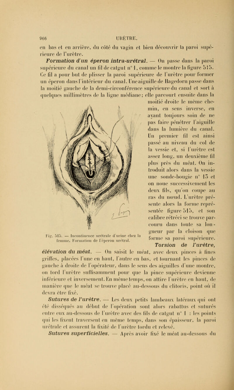 en bas et en arrière, du côté du vagin et bien découvrir la paroi supé- rieure de l'urètre. Formation dun éperon intra-urétral. — On passe dans la paroi supérieure du canal un fil de catgut n° 1, comme le montre la figure 515. Ce fil a pour but de plisser la paroi supérieure de l'urètre pour former un éperon dans l'intérieur du canal. Une aiguille de Hagedorn passe dans la moitié gauche de la demi-circonférence supérieure du canal et sort à quelques millimètres de la ligne médiane; elle parcourt ensuite dans la moitié droite le même che- min, en sens inverse, en ayant toujours soin de ne pas faire pénétrer l'aiguille dans la lumière du canal. Un premier fil est ainsi passé au niveau du col de la vessie et, si l'urètre est assez long, un deuxième fil plus près du méat. On in- troduit alors dans la vessie une sonde-bougie n° 13 et on noue successivement les deux fils, qu'on coupe au i'as du nœud. L'urètre pré- sente alors la forme repré- sentée figure 515, et sou calibre rétréci se trouve par- couru dans toute sa Ion - gueur par la cloison que forme sa paroi supérieure. Torsion de l'urètre, élévation du méat. — On saisit le méat, avec deux pinces à fines griffes, placées l'une en haut, l'autre en bas, et tournant les pinces de gauche à droite de l'opérateur, dans le sens des aiguilles (finie montre, on lord l'urètre suffisamment pour que la pince supérieure devienne inférieure el inversement. En même temps, on attire l'urètre en haut, de manière que le méat se trouve placé au-dessous du clitoris, poinl où il devin être li\é. Sutures de F urètre.— Les deux petits lambeaux latéraux qui ont été disséqués au début de l'opération sont alors rabattus el suturés entre eux au-dessous de l'urètre avec des lils de catgut n I : les points qui les lixenl Iraversenl en même temps, dans son épaisseur, la paroi urétrale el assurent la fixité de l'urètre tordu et relevé. Sutures superficielles. -- Après avoir i\\^ le méat au-dessous du Fig. 515. — tncontinence urétrale d'urine chez la femme. Formation de l'éperon urétral.