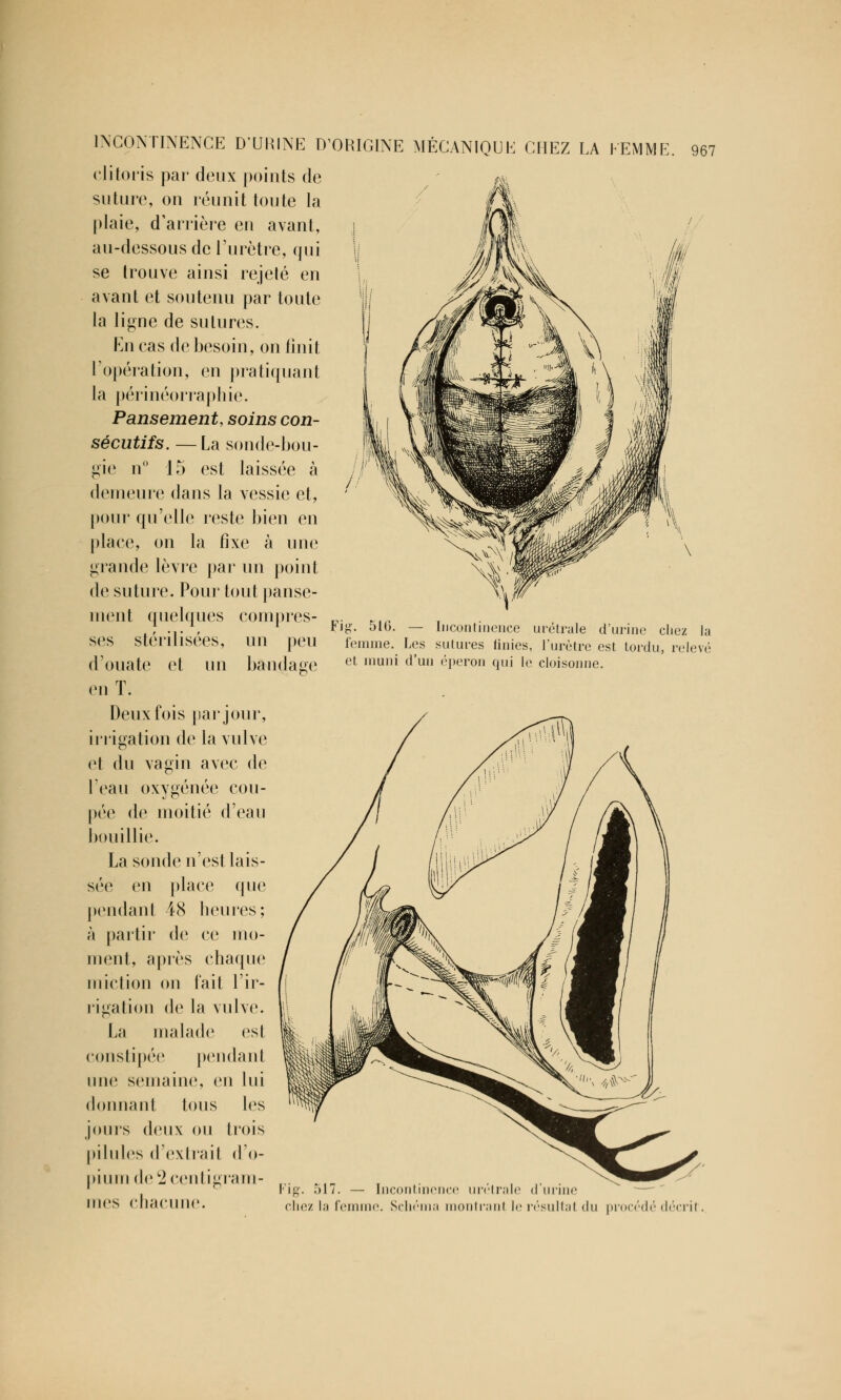 clitoris par deux points de suture, on réunit toute la plaie, d'arrière en avant, au-dessous de l'urètre, qui se Irouve ainsi rejelé en avant et soutenu par toute la ligne de sutures. En cas de besoin, on finit l'opération, en pratiquant la périnéorraphie. Pansement, soins con- sécutifs. — La sonde-bou- gie n° 15 est laissée à demeure dans la vessie et, pour qu'elle reste bien en place, on la fixe à une grande lèvre par un point de suture. Pour tout panse- ment quelques compres- ses stérilisées, un peu d'ouate et un en T. Deux fois par joui Fiff. bandage — Incontinence urétrale d'urine cliez la femme. Les sutures finies, l'urètre est tordu, relevé et muni d'un éperon qui le cloisonne. irrigation de la vulve et du vagin avec de 1 eau oxygénée cou- pée de moitié d'eau bouillie. La sonde n'est lais- sée en place que pendant 48 heures; à partir de ce mo- ment, après chaque miction on fait l'ir- rigation de la vulve. La malade est constipée pendant une semaine, en lui donnant tous les jouis deux ou trois pilules d'extrait d'o- pium de 2 centigram- mes chacune. chez l;i femi Schéma monl résultat <lu procédé décril.