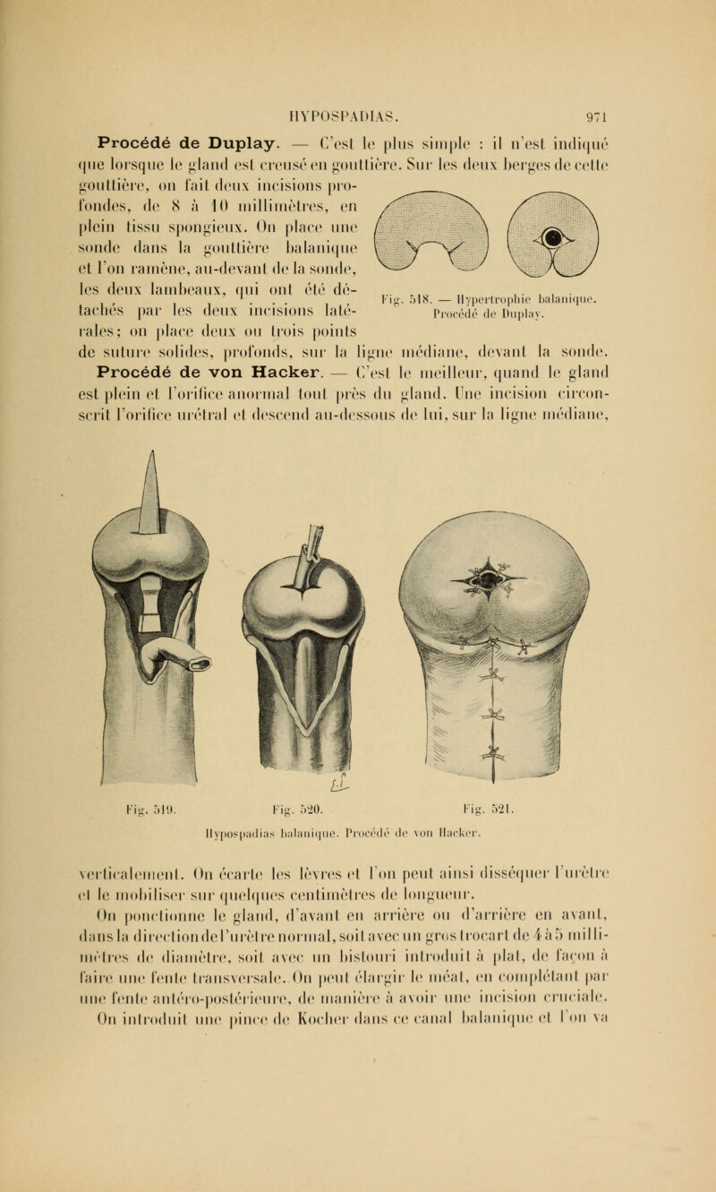 Procédé de Duplay. — C'est le plus simple : il n'est indiqué que lorsque le gland est creusé en gouttière. Sur les deux berges de cette gouttière, on fait deux incisions pro- fondes, de 8 à 10 millimètres, en plein tissu spongieux. On place une sonde dans la gouttière balanique et l'on ramène, au-devant de la sonde, les deux lambeaux, qui ont été dé- tachés par les deux incisions laté- rales; on place deux ou trois points de suture solides, profonds, sur la ligne médiane, devant la sonde. Procédé de von Hacker. — C'est le meilleur, quand le gland est plein et l'orifice anormal tout près du gland. Une incision circon- scrit l'orifice urétral et descend au-dessous de lui, sur la ligne médiane, 518. — Hypertrophie balaniqu< Procédé de Duplay. Fig. 519. Fig. 520. Fig. 521. llypospadias balanique. Procédé de von Hacker. verticalement. On écarte les lèvres et l'on peut ainsi disséquer l'urètre el le mobiliser sur quelques centimètres de longueur. On ponctionne le gland, d'avant en arrière ou d'arrière en avant, dans la direction de l'urètre normal, soit avec un grostrocartde 4à5 milli- mètres de diamètre, soit avec un bistouri introduit à plat, de façon à faire une fente transversale. On peut élargir le méat, en complétant par une lente anléro-postérieure, de manière à avoir une incision cruciale. On introduit une pince de Kocher dans ce canal balanique et l'on va