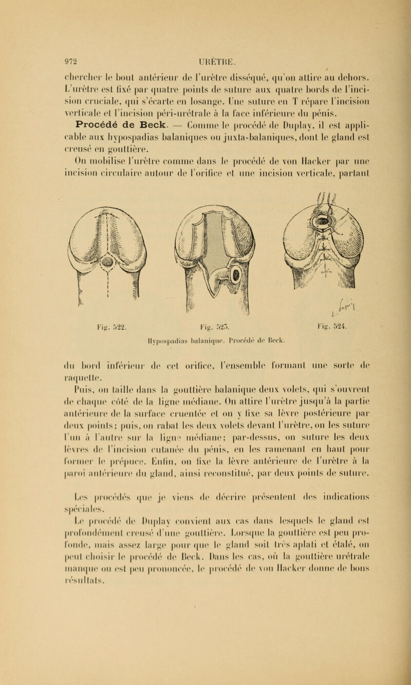 chercher le bout antérieur de l'urètre disséqué, qu'on attire au dehors. L'urètre est fixé par quatre points de suture aux quatre bords de l'inci- sion cruciale, qui s'écarte en losange. Une suture en T répare l'incision verticale et l'incision péri-urétrale à la l'ace inférieure du pénis. Procédé de Beck. — Connue le procédé de Duplay, il est appli- cable aux liypospadias balaniques ou juxta-balaniques, dont le gland est creusé en gouttière. On mobilise l'urètre comme dans le procédé de von Hacker par une incision circulaire autour de l'orifice et une incision verticale, partant Fis-. 522. r l Fig. 523. [ypospadias balanique. Procédé de Beck. Vis. 524. du bord inférieur de cet orifice, l'ensemble formanl une sorte de raquette. Puis, on taille dans la gouttière balanique deux volets, qui s'ouvrent de chaque côté de la ligne médiane. On attire l'urètre jusqu'à la partie antérieure de la surface cruentée et on y tîxe sa lèvre postérieure par deux points; puis, on rabat les deux volets devant l'urètre, on les suture l'un à l'autre sur la ligne médiane; par-dessus, on suture les deux lèvres de l'incision cutanée du pénis, en les ramenant en haut pour former le prépuce. Enfin, on fixe la lèvre antérieure de l'urètre à la paroi antérieure du gland, ainsi reconstitué, par deux points de suture. Les procédés que je viens de décrire présentent des indications spéciales. Le procédé de Duplay convient aux cas dans lesquels le gland est profondément creusé d'une gouttière. Lorsque la gouttière est peu pro- fonde, mais assez large pour (pie le gland soit 1res aplati et étalé, on peut choisir le procédé de Beck. Dans les cas, où la gouttière urélrale manque ou est peu prononcée, le procédé de von Hacker donne de bons résultats.