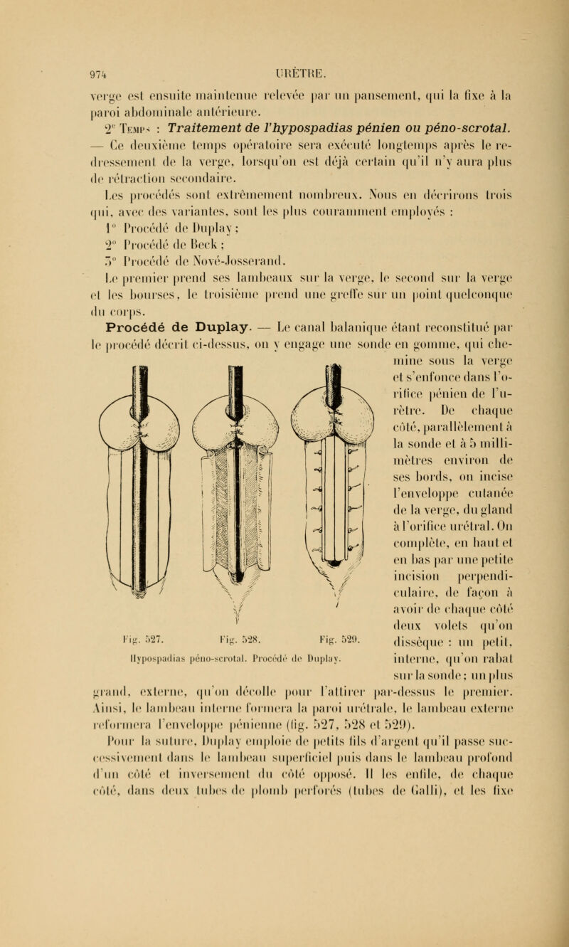 verge est ensuite maintenue relevée par un pansement, qui la fixe à la paroi abdominale antérieure. C2C Temps : Traitement de l'hypospadias pénien ou péno-scrotal. — Ce deuxième temps opératoire sera exécuté longtemps après le re- dressement de la verge, lorsqu'on est déjà certain qu'il n'y aura plus de rétraction secondaire. Les procédés sont extrêmement nombreux. Nous en décrirons trois qui, avec des variantes, sont les plus couramment employés : 1 ° Procédé de Duplay ; 2° Procédé de Beck ; 3° Procédé de Nové-Josserand. Le premier prend ses lambeaux sur la verge, le second sur la verge et les bourses, le troisième prend une greffe sur un point quelconque du corps. Procédé de Duplay. — Le canal balanique étant reconstitué par le procédé décrit ci-dessus, on y engage une sonde en gomme, qui che- mine sous la verge et s'enfonce dans l'o- rifice pénien de l'u- rètre. De chaque coté, parallèlement à la sonde et à 5 milli- mètres environ de ses bords, on incise l'enveloppe cutanée de la verge, du gland à l'orifice urétral. On complète, en haul el en bas par une petite incision perpendi- culaire, de façon à avoir de chaque côté deux volets qu'on dissèque : un petit, interne, qu'on rabat sur la soude; un plus grand, externe, qu'on décolle pour l'attirer par-dessus le premier. Ainsi, le lambeau interne formera la paroi urétrale, le lambeau externe reformera l'enveloppe pénienne (fig. 527, 528 et 5*29). Pour la suture, Duplay emploie de petits (ils d'argent qu'il passe suc- cessivement dans le lambeau superficiel puis dans le lambeau profond d'un côté el inversement du côté opposé. Il les enfile, de chaque côté, dans deux tubes de plomb perforés (tubes de Galli), et les fixe Vis. 527. >2fr. Fig. 529. Ilypospadias péno-scrotal. Procédé de Duplay.