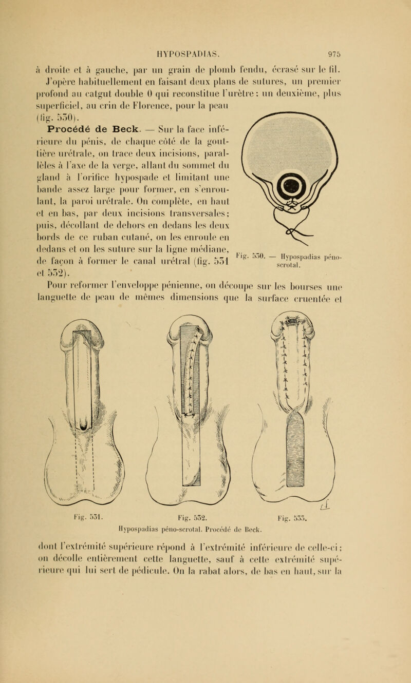 à droite et à gauche, par un grain de plomb fendu, écrasé sur le fil. J'opère habituellement en faisant deux plans de sutures, un premier profond au catgut double 0 qui reconstitue l'urètre; un deuxième, plus superficiel, au crin de Florence, pour la peau (fig. 530). Procédé de Beck. — Sur la face infé- rieure du pénis, de chaque côté de la gout- tière urétrale, on trace deux incisions, paral- lèles à Taxe de la verge, allant du sommet du gland à l'orifice hypospade et limitant une bande assez large pour former, en s'enrou- lant, la paroi urétrale. On complète, en haut et en bas, par deux incisions transversales; puis, décollant de dehors en dedans les deux bords de ce ruban cutané, on les enroule en dedans et on les suture sur la ligne médiane, de façon à former le canal urétral (fig. 551 et 552). Pour reformer l'enveloppe pénienne, on découpe sur les bourses une languette de peau de mômes dimensions que la surface cruentée et Fig. 530. • Hypospadias péno- scrotal. Fig. 531. Fig. 532. Hypospadias péno-scrotal. Procédé de Dock. Fig. 535. dont l'extrémité supérieure répond à l'extrémité inférieure de ce on décolle entièrement cette languette, sauf à celle extrémité rieure qui lui sert de pédicule. On la rabat alors, de bas en haut, lle-ci supé sur I;